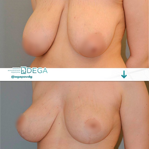 Редукционная маммопластика (уменьшение груди)