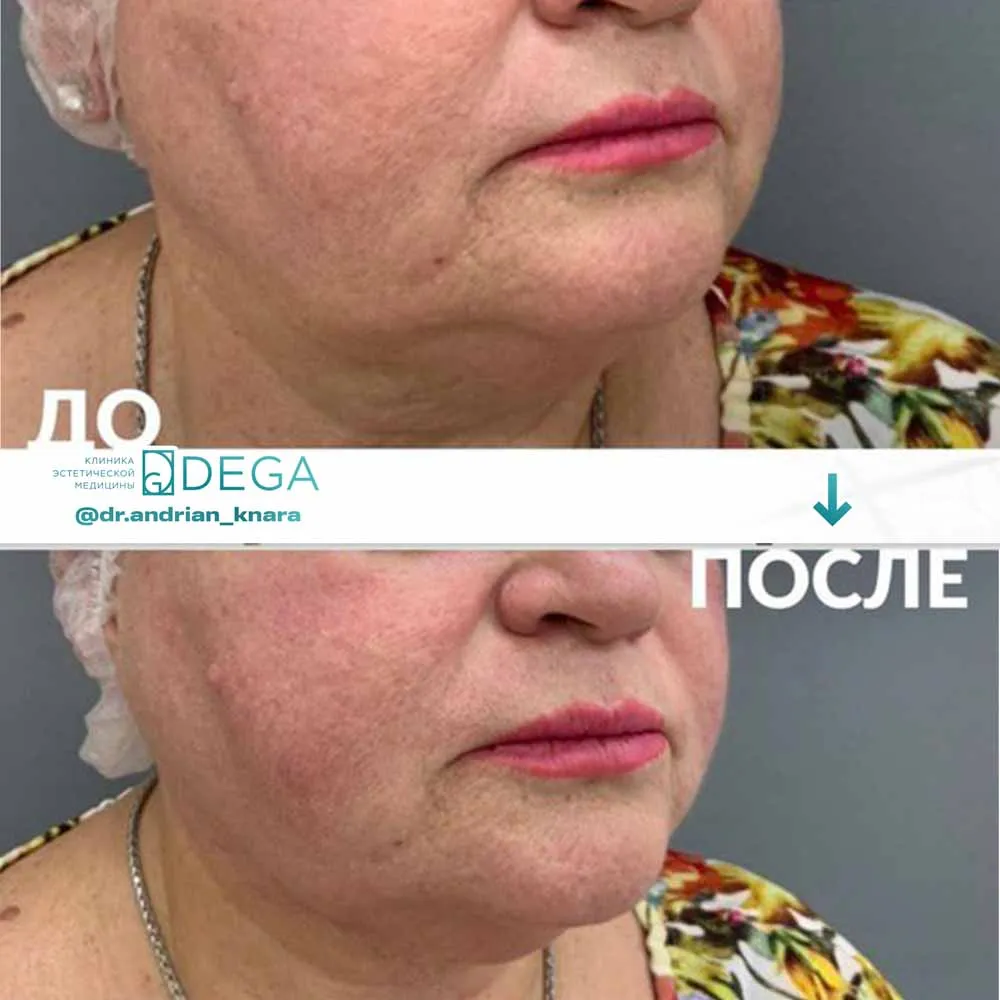 Андрян КВ - SMAS-лифтинг №4