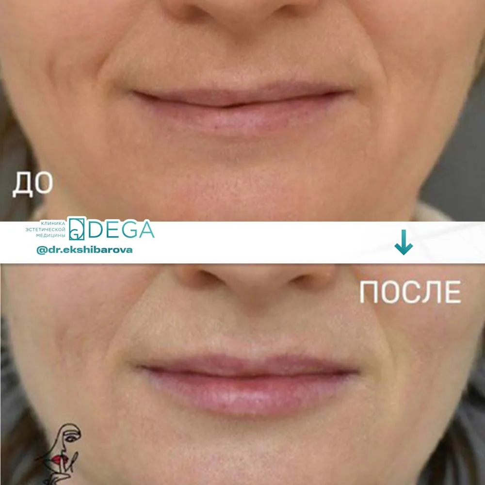 Екшибарова НИ - Ботулинотерапия, Контурная пластика №3