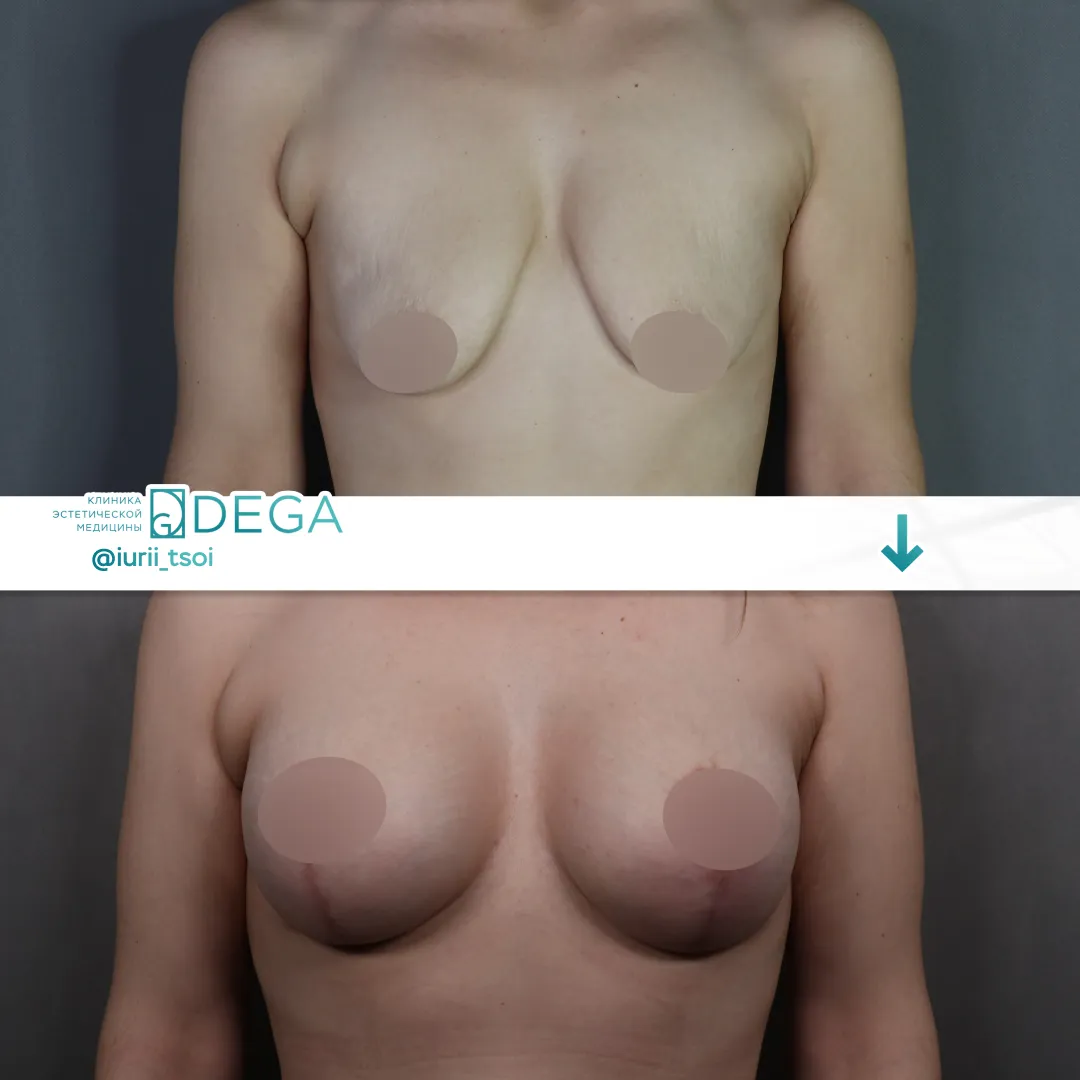 Цой ЮР - Мастопексия №14