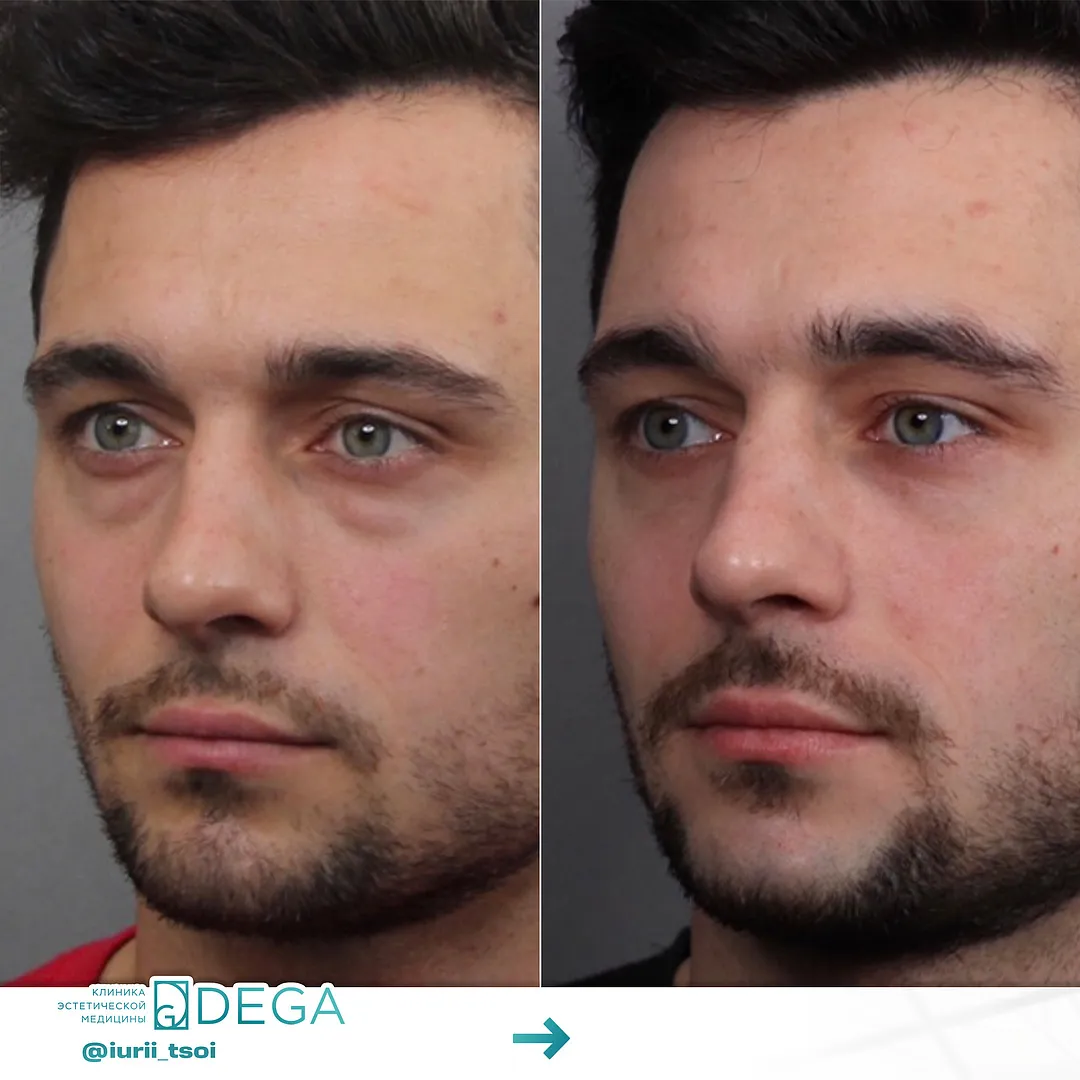 Цой ЮР - Блефаропластика №23