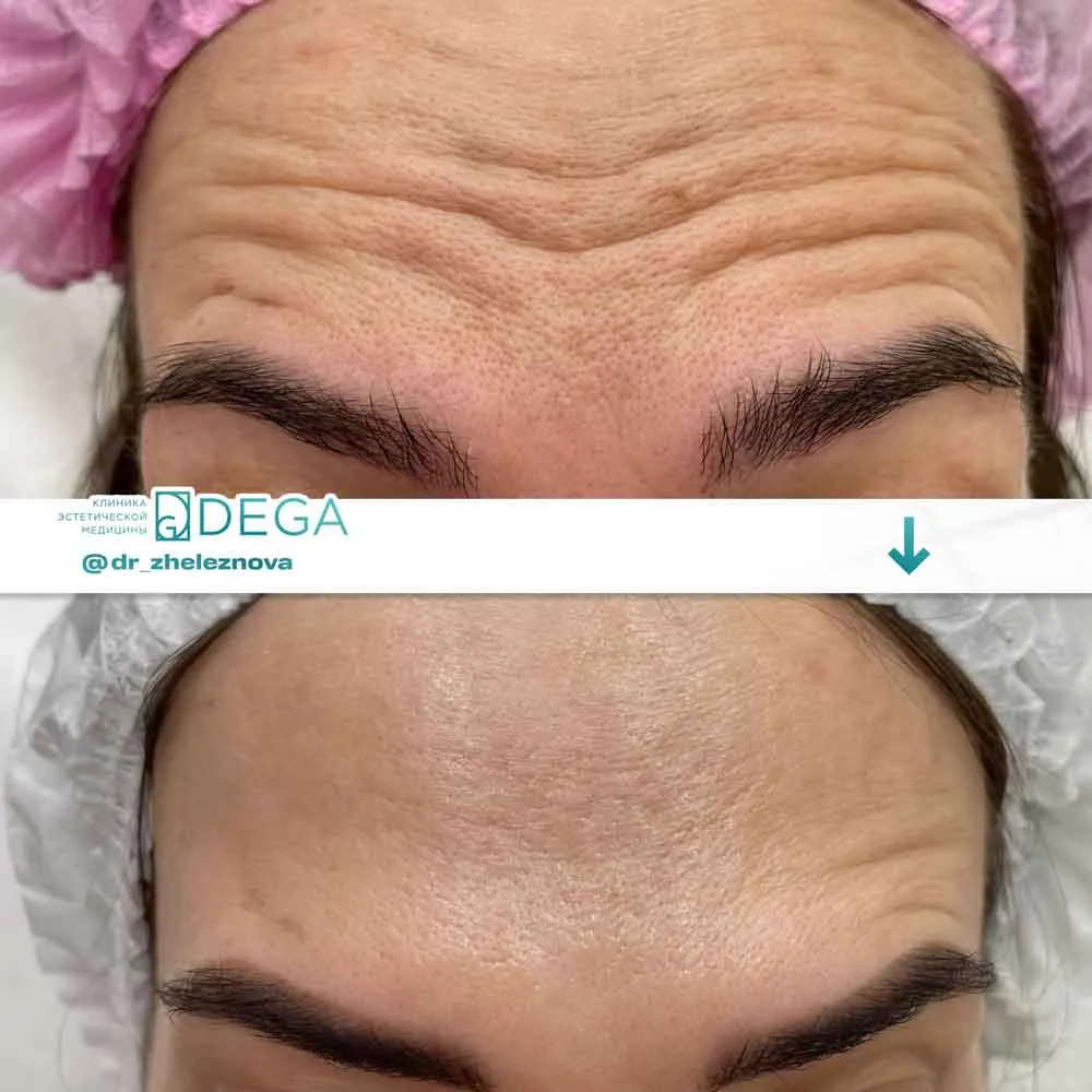 Железнова Яна Алексеевна - Ботокс №7