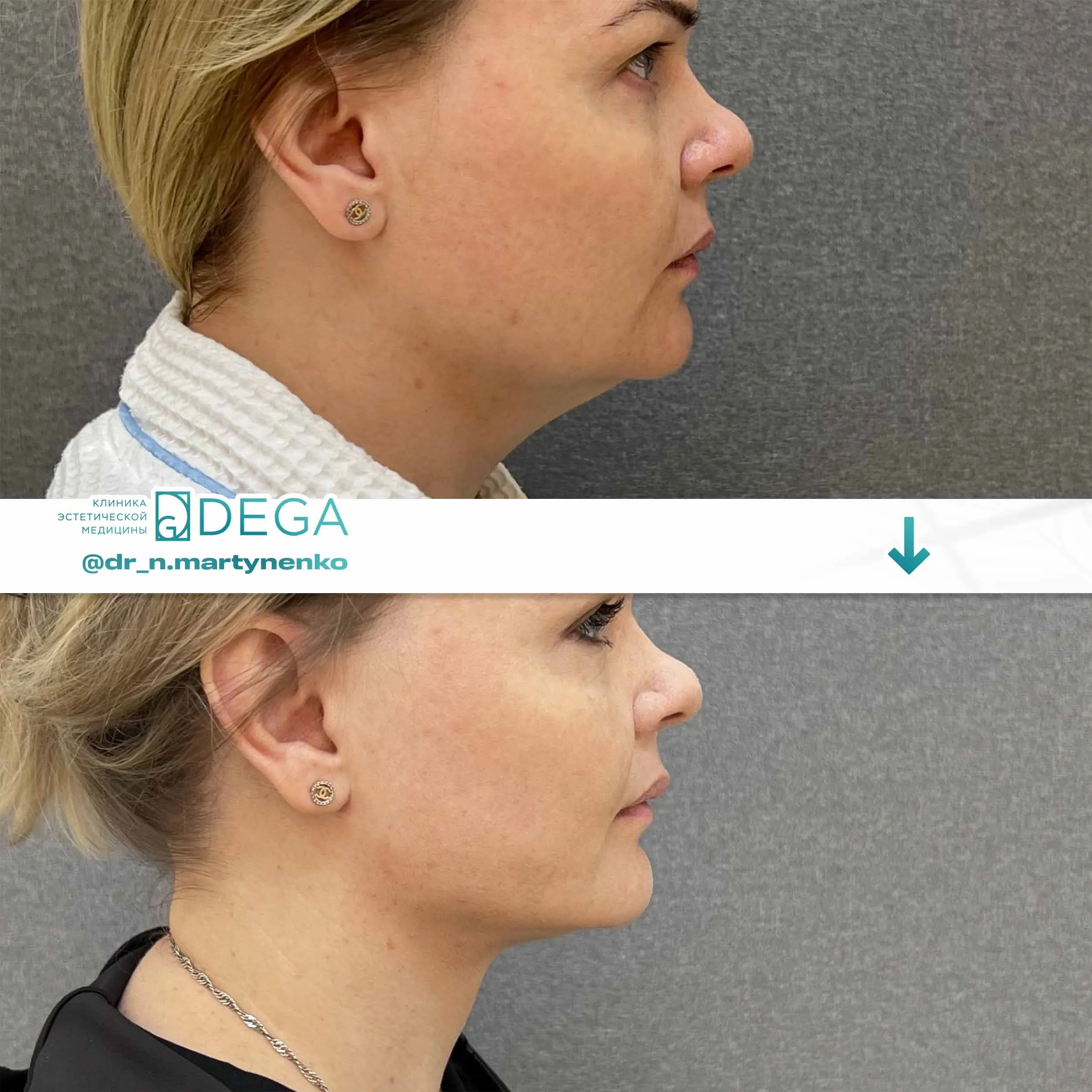 Мартыненко Н. А. — №10 Липосакция подбородка