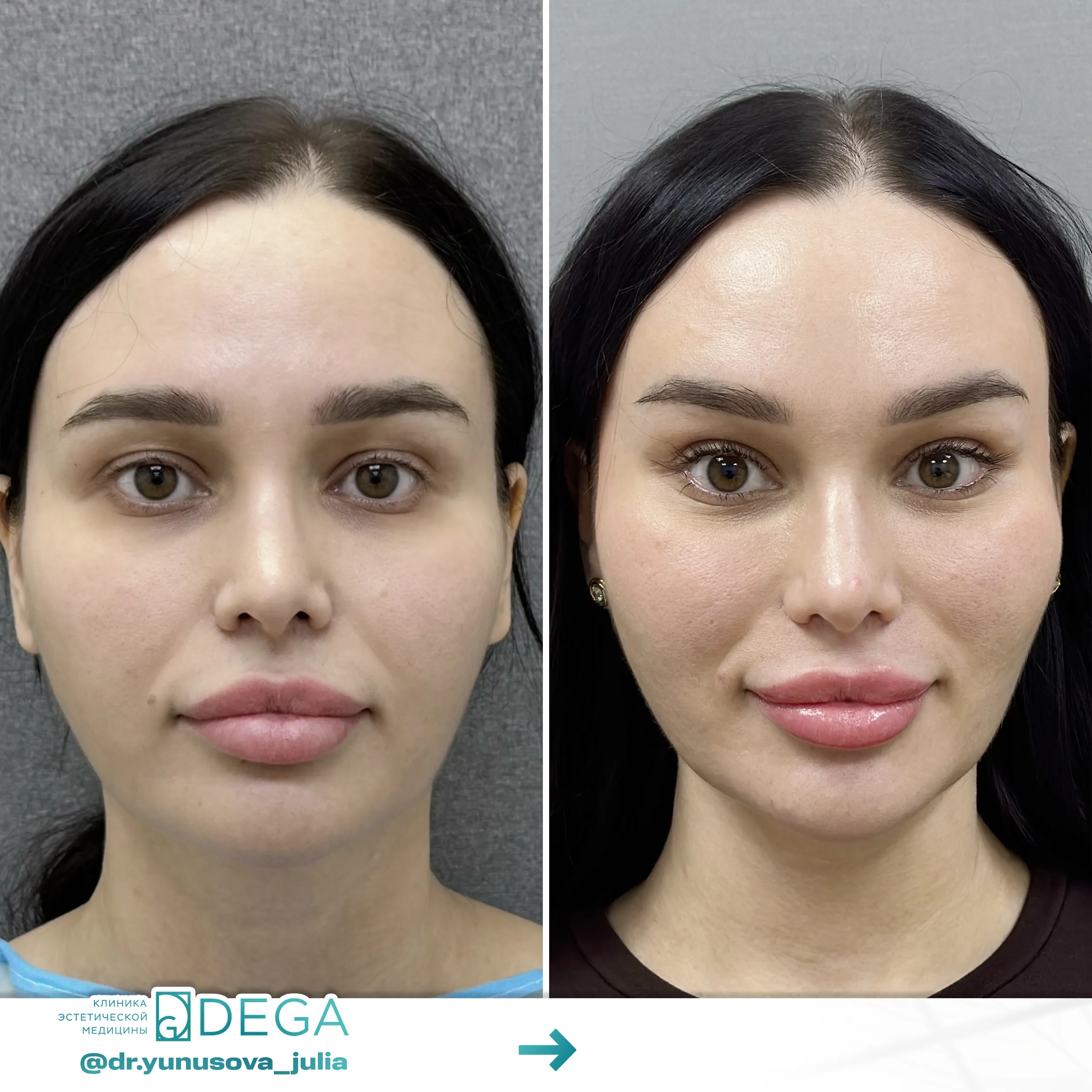 Юнусова ЮР - Эндоскопическая подтяжка лица №50