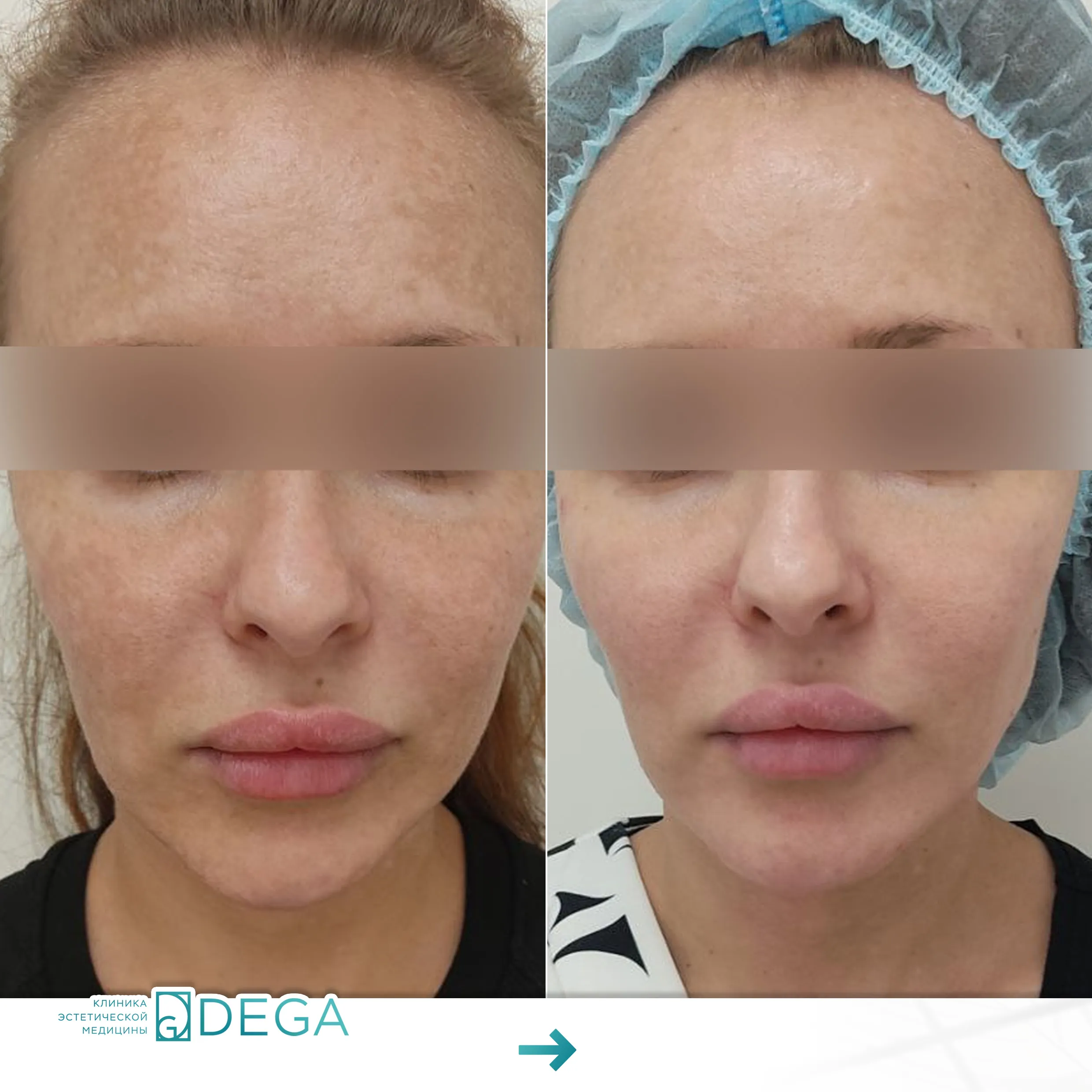 Бабичева С.Ю. — Фотодинамическая терапия №3