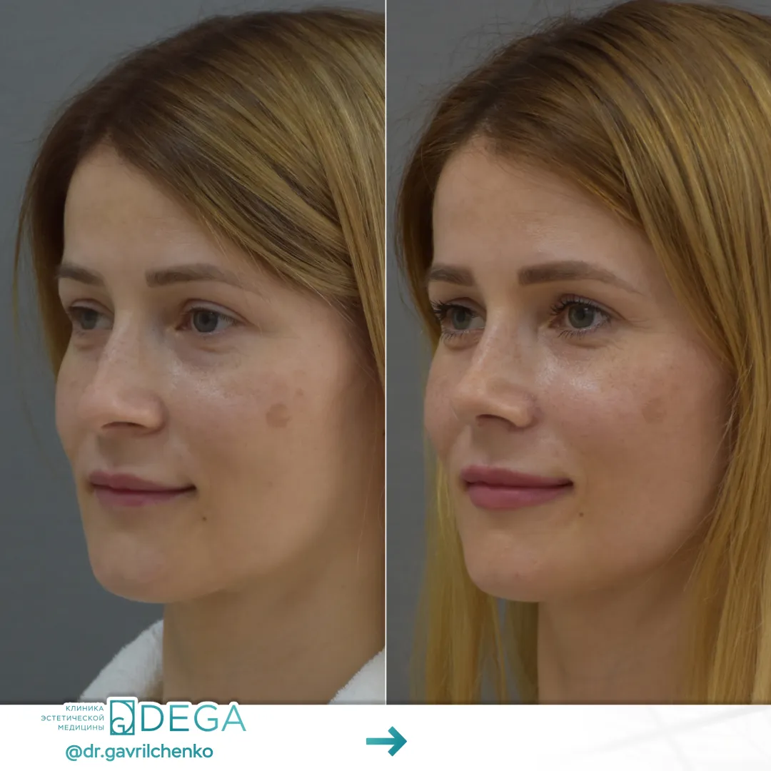 Гаврильченко АА - Ринопластика №26