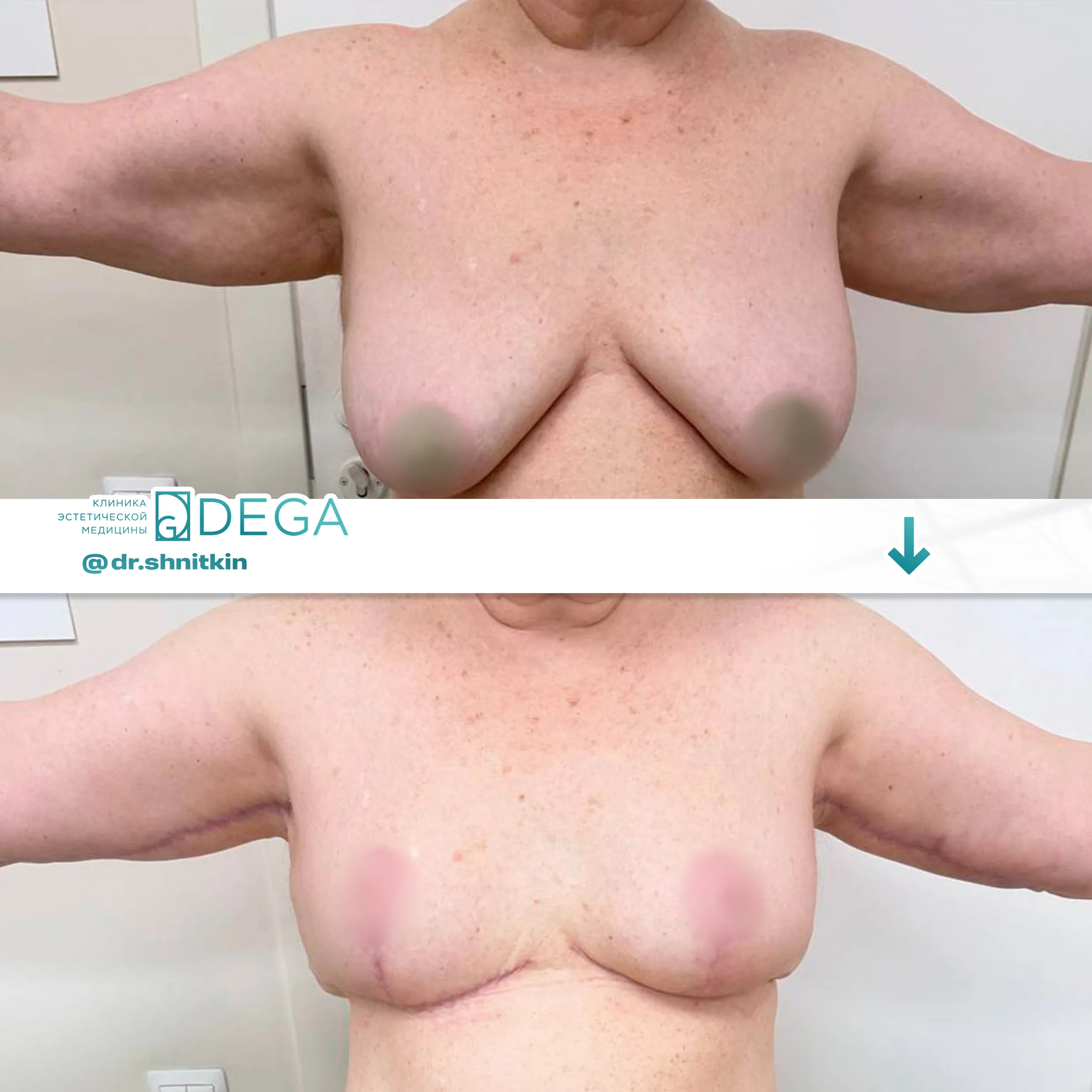 Шниткин Антон Сергеевич - Мастопексия (подтяжка груди), Липосакция лица, Брахиопластика (пластика рук) №28