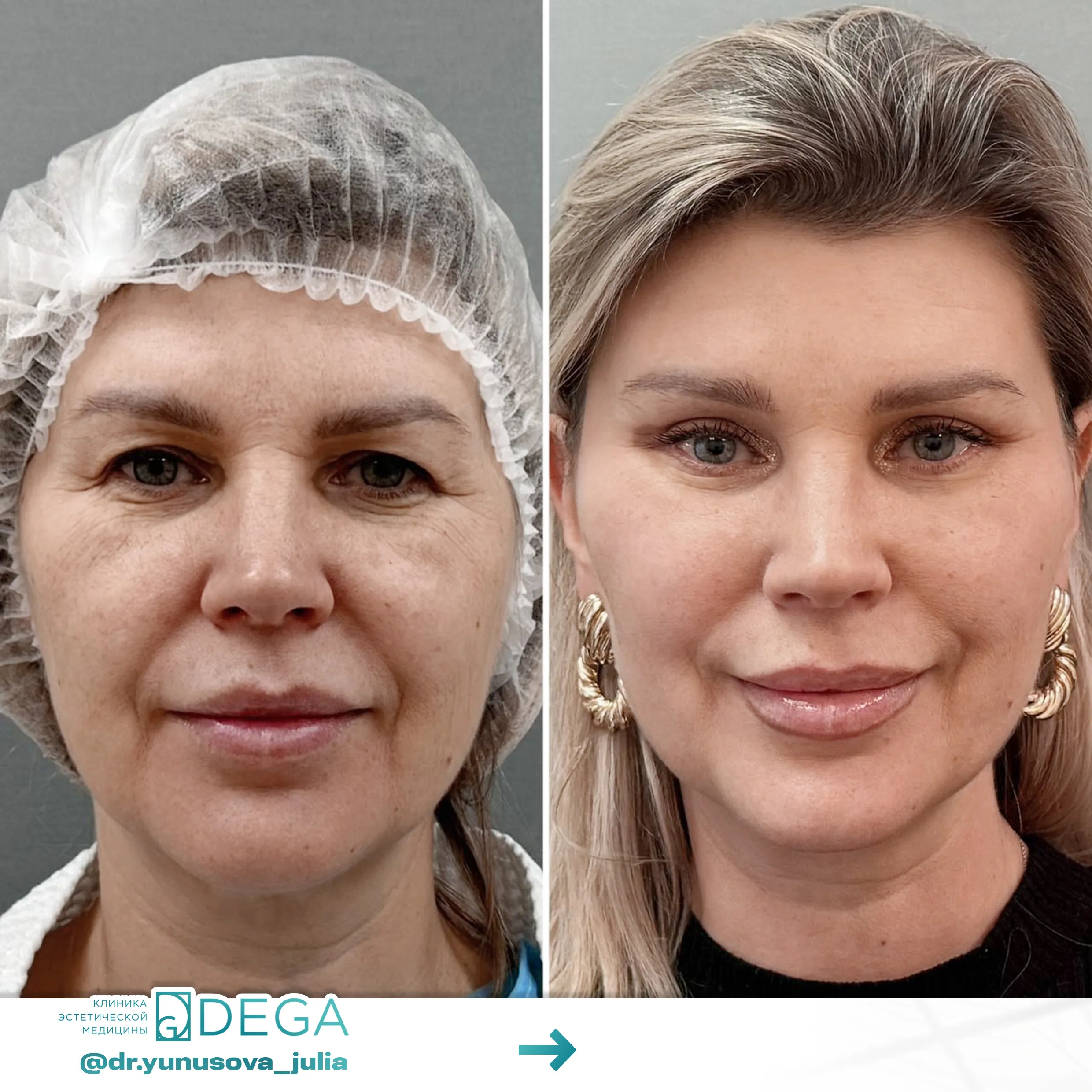 Юнусова ЮР - Эндоскопическая подтяжка лица №56