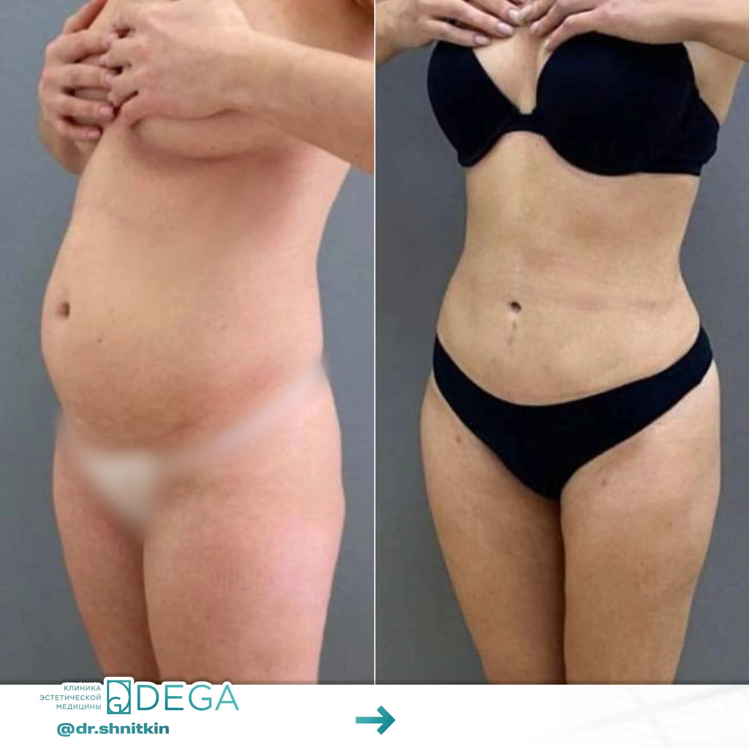 Шниткин Антон Сергеевич №23.1 Абдоминопластика (пластика живота) Пластика тела