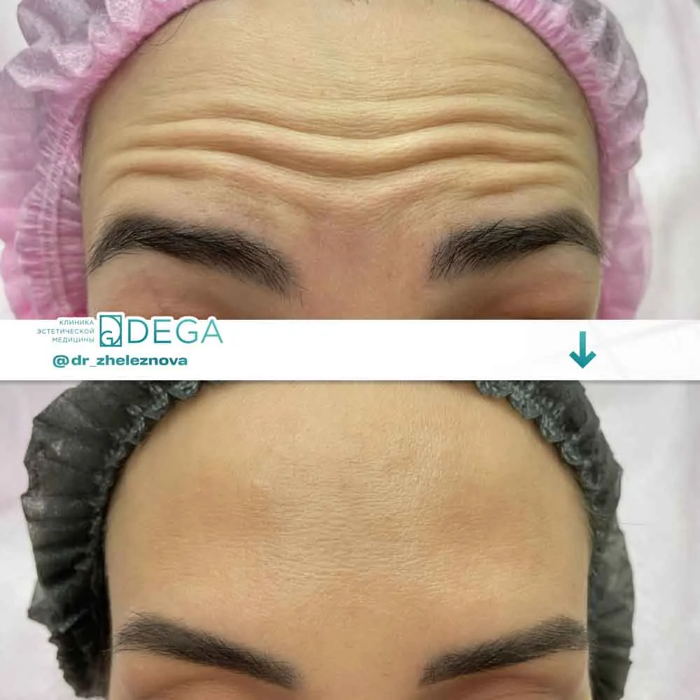 Железнова Яна Алексеевна - Ботокс №5