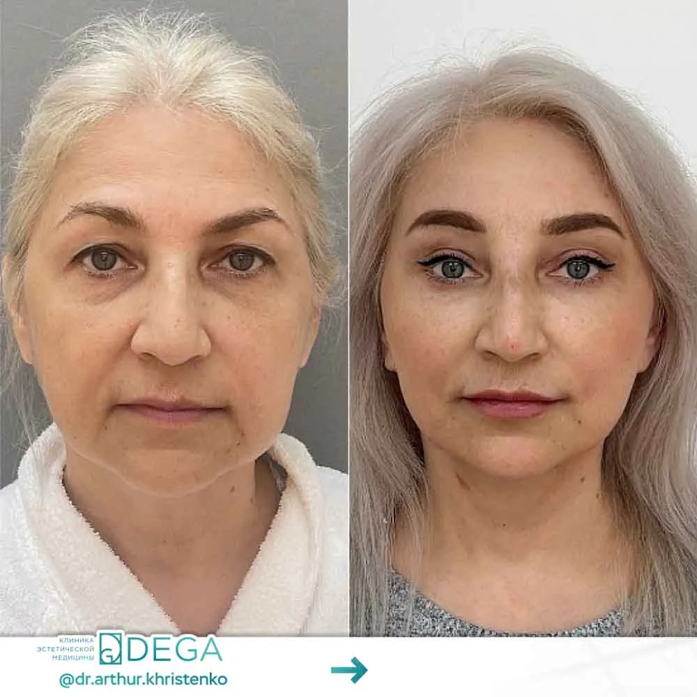 Христенко АА - Контурная пластика губ, Эндоскопическая периорбитопластика №2