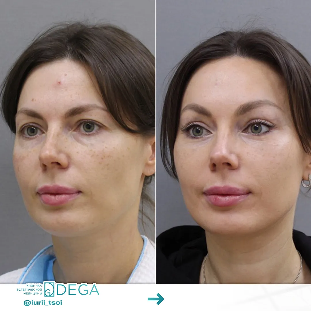 Цой ЮР - Блефаропластика, Эндоскопическая подтяжка №26