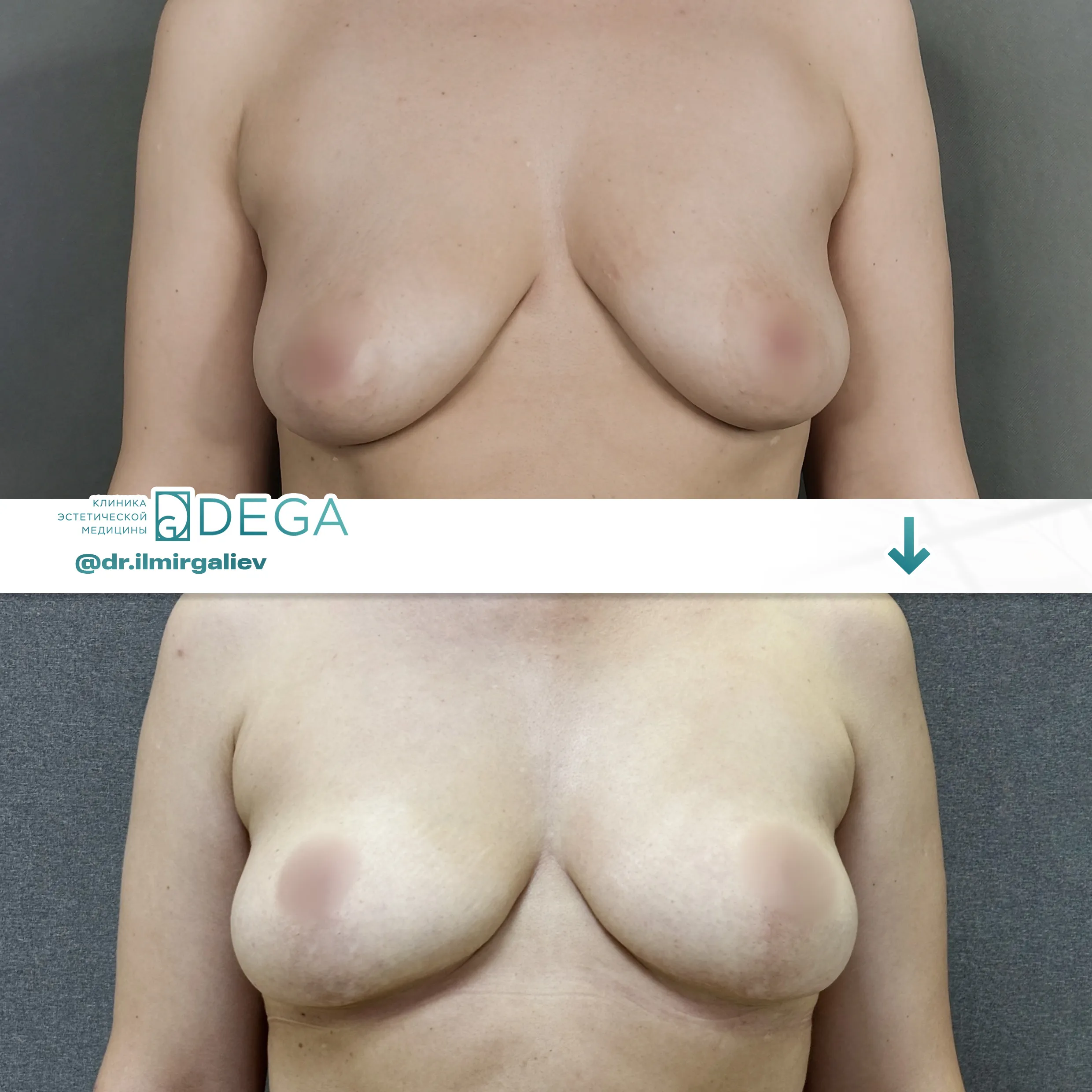 Галиев Ильмир Амирович №13 Мастрпексия