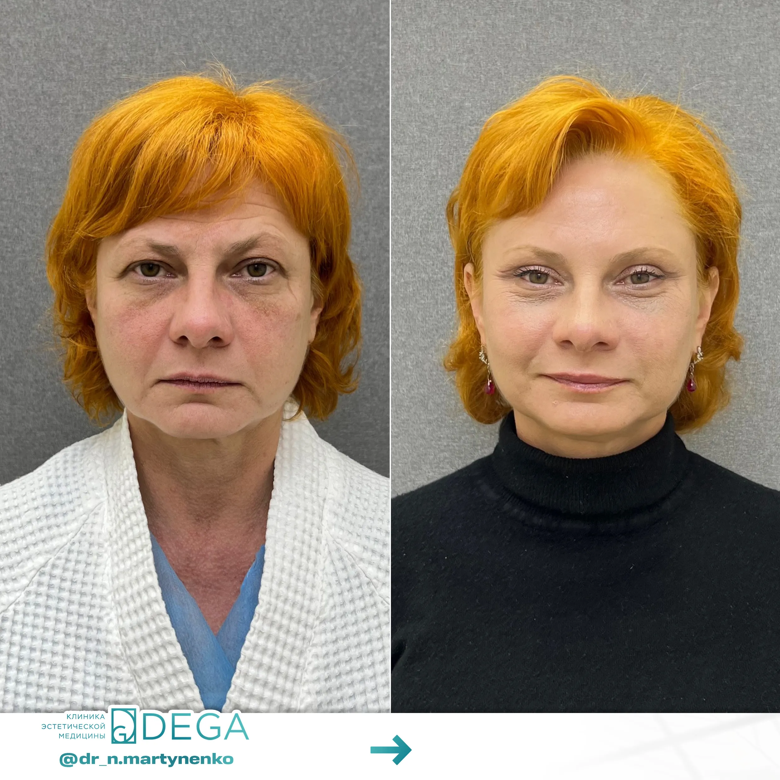 Мартыненко Н. А. — Эндоскопическая подтяжка лица №13