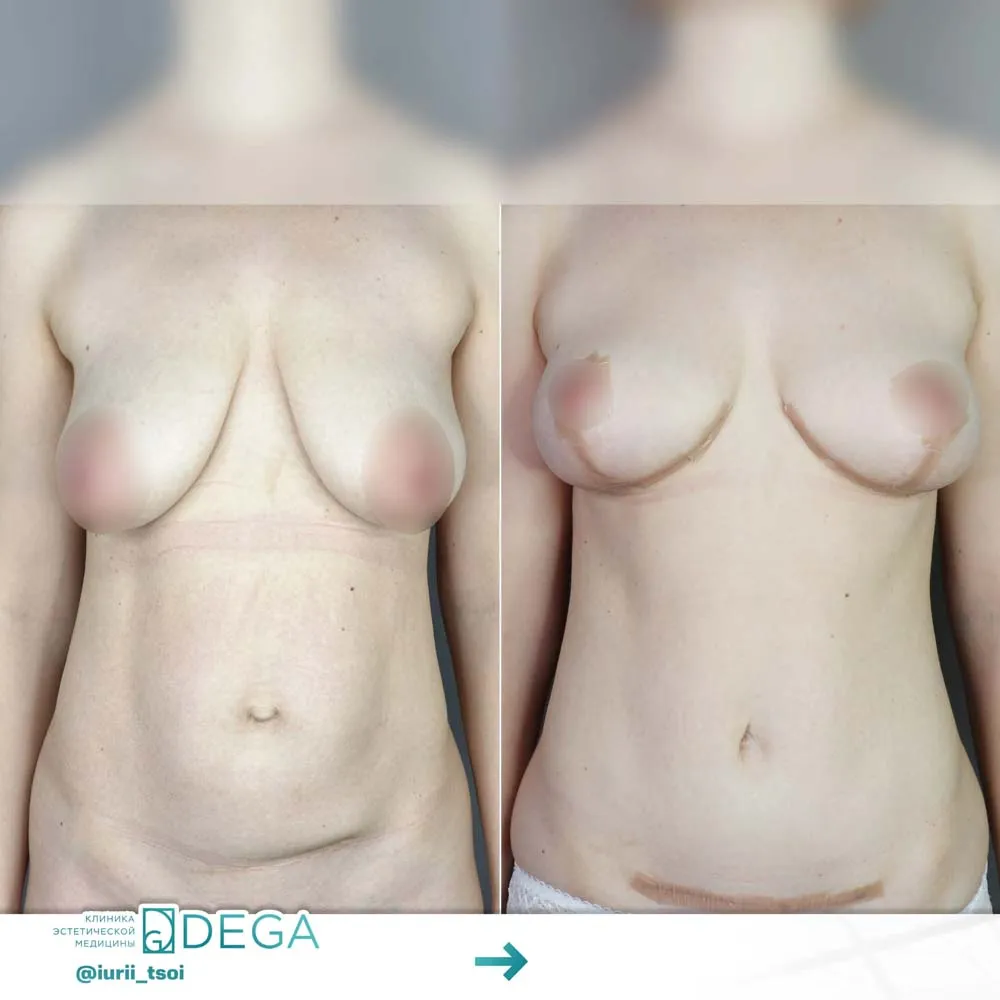 Цой ЮР - Миниабдоминопластика, Мастопексия №6