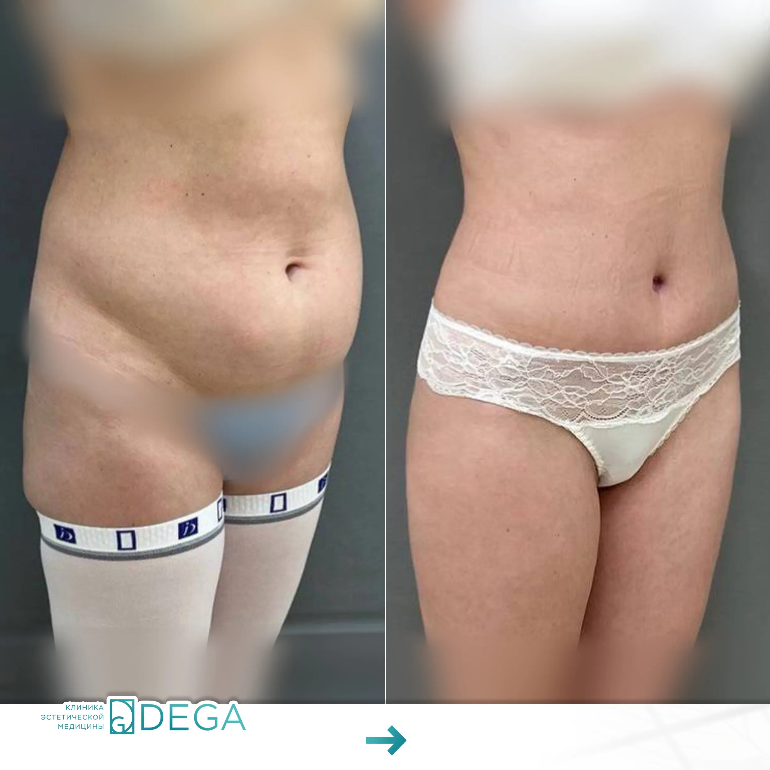 Шорников Евгений Сергеевич №12.1 Пластика тела Абдоминопластика (пластика живота)