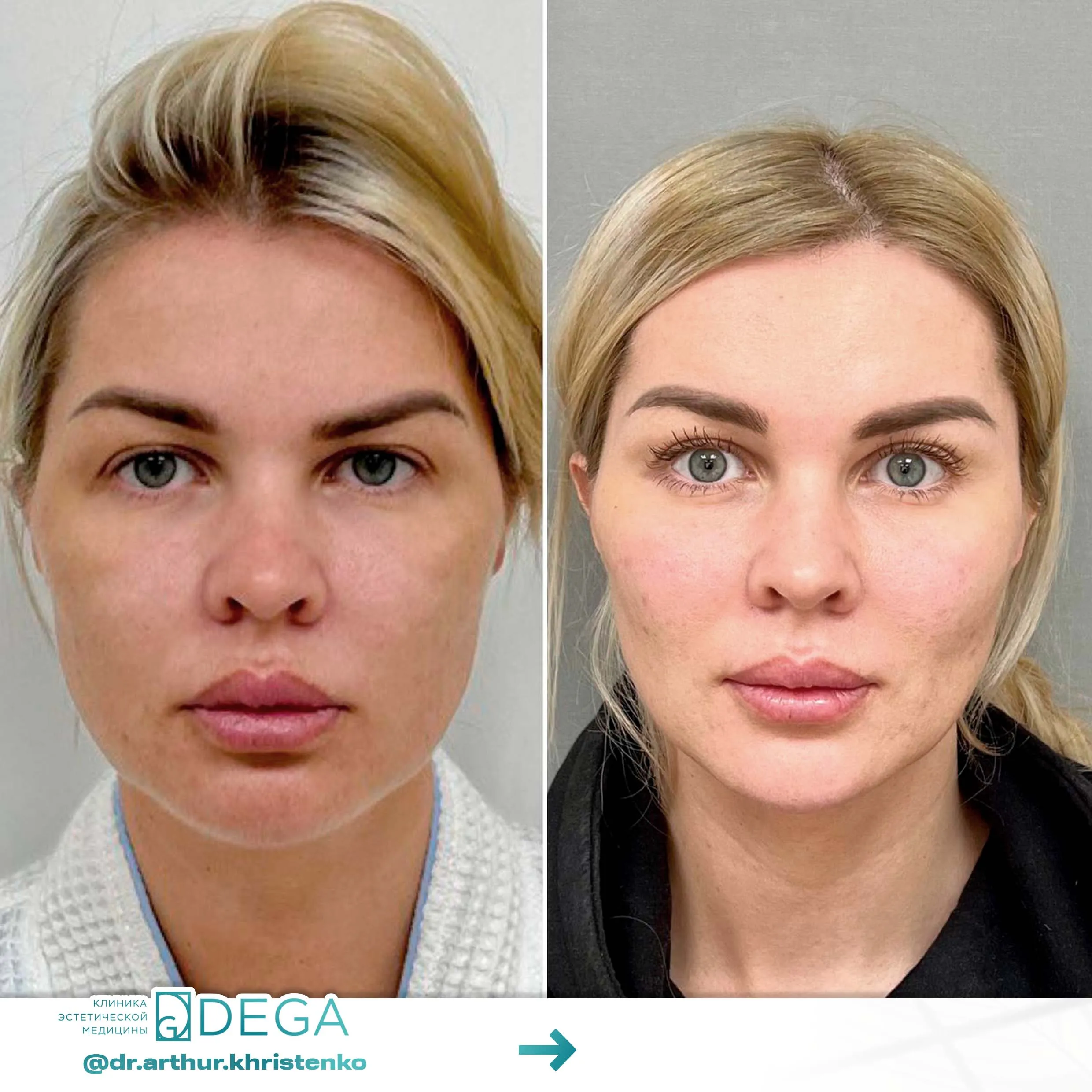 Христенко АА - ESP-Lifting, Эндоскопическая подтяжка, Фейслифтинг, Платизмопластика №26