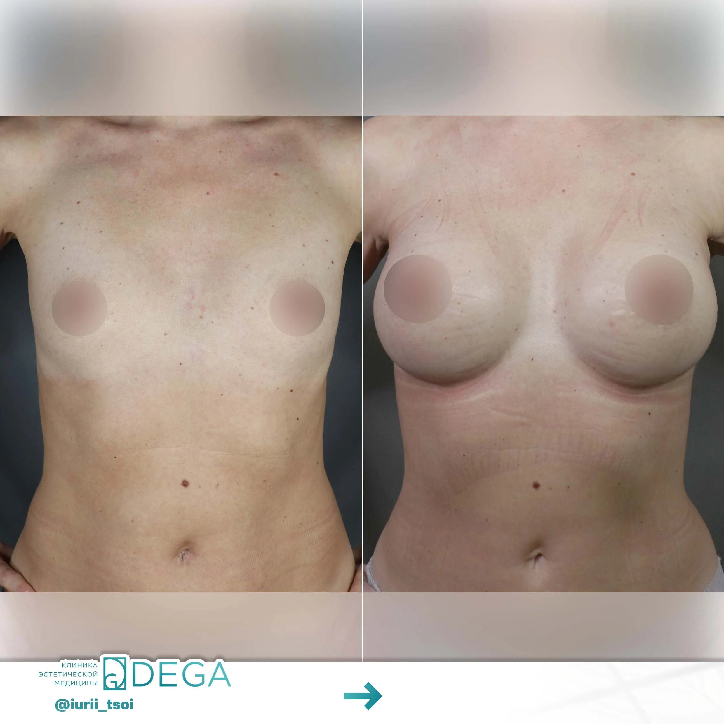 Цой ЮР - Увеличение груди №12
