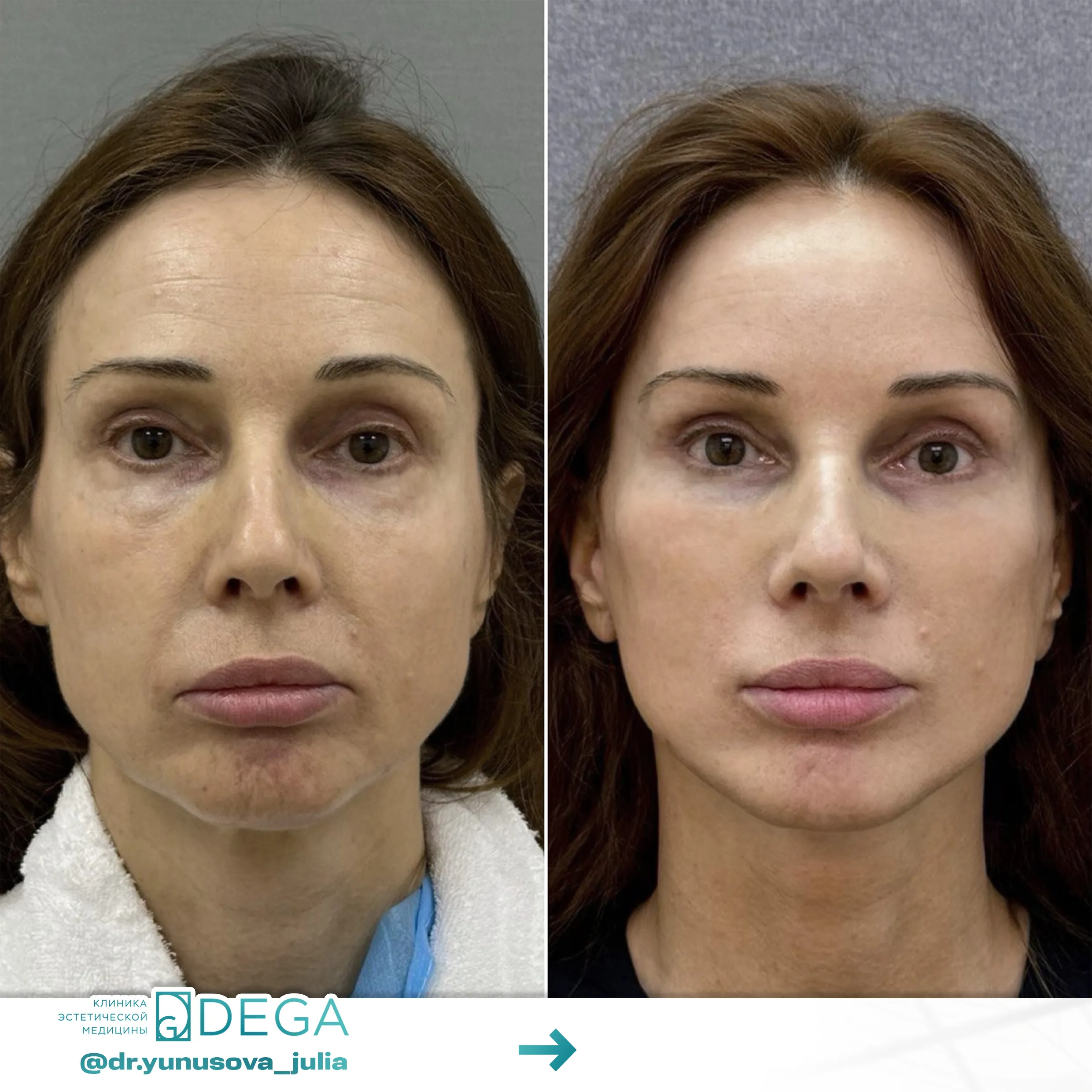 Юнусова ЮР - Эндоскопическая подтяжка лица, Фейслифтинг, Платизмопластика  №47