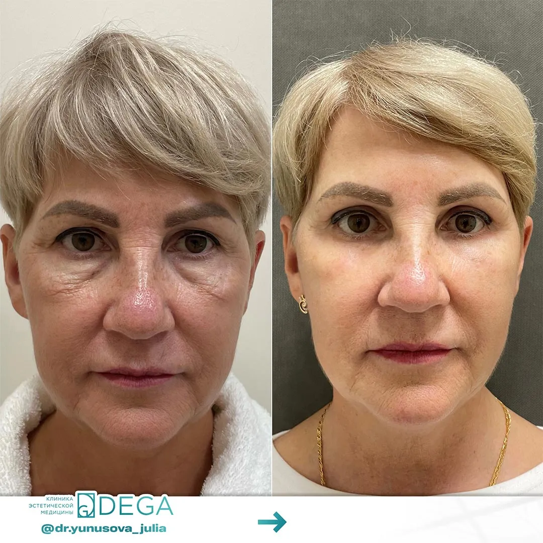 Юнусова ЮР - Блефаропластика №8