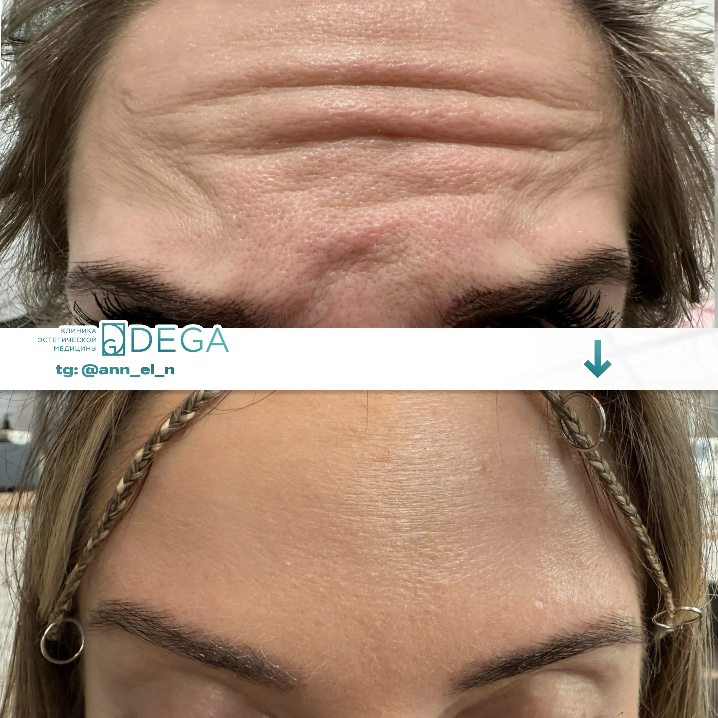 Дулмаева А.О. - Ботулинотерапия №2