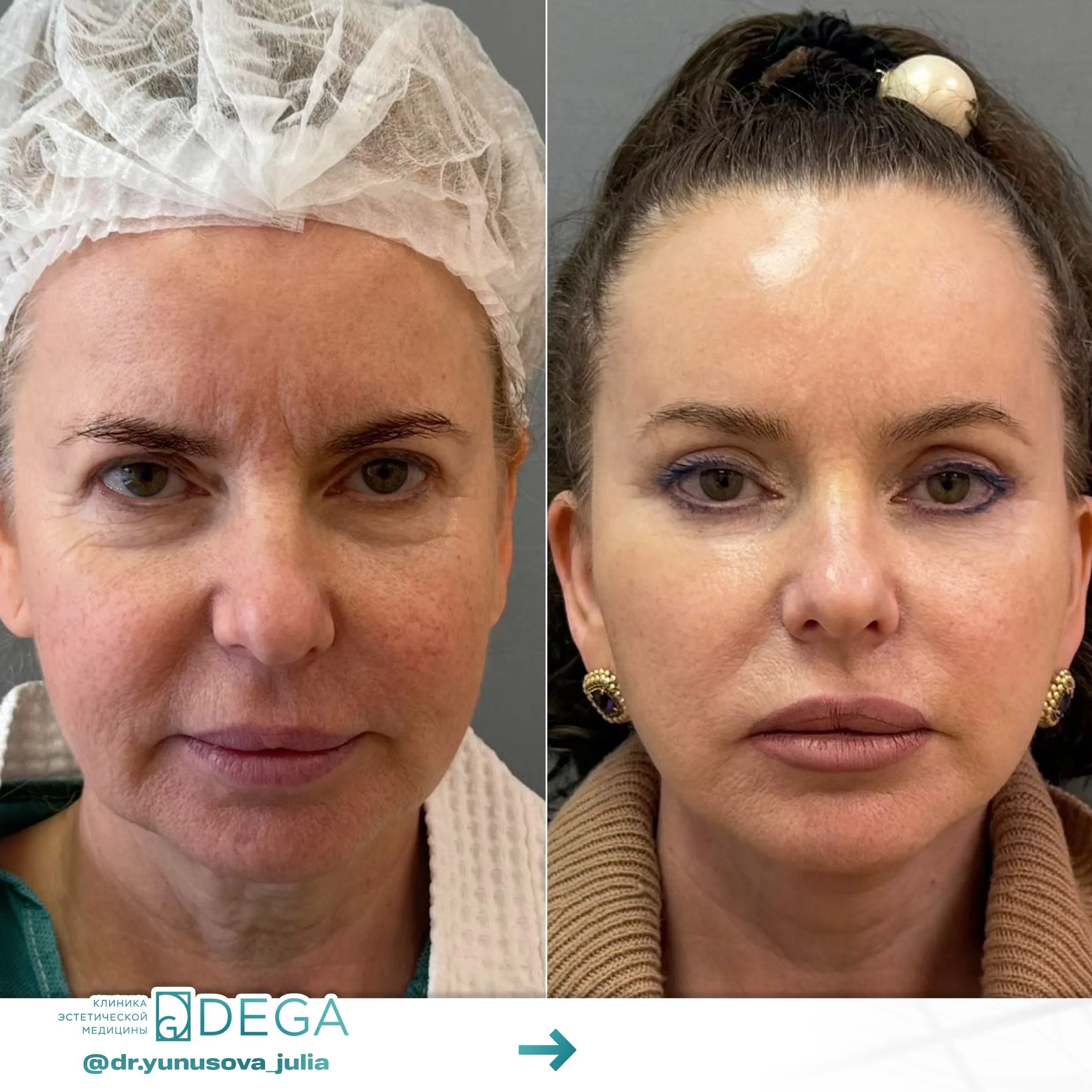 Юнусова ЮР - Блефаропластика, Фейслифтинг, Платизмопластика №66