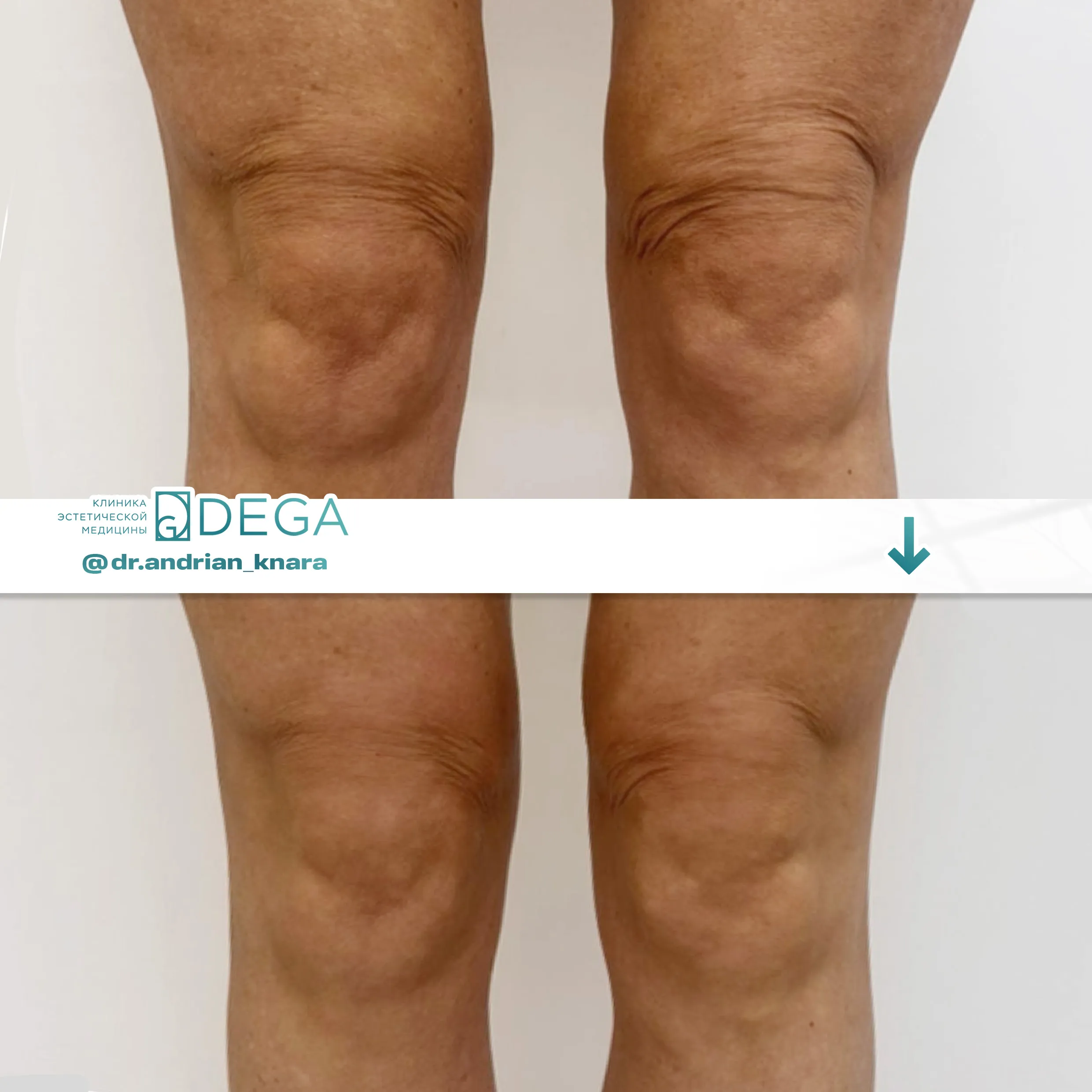 Андрян КВ - Монополярный RF-лифтинг Oligio №28