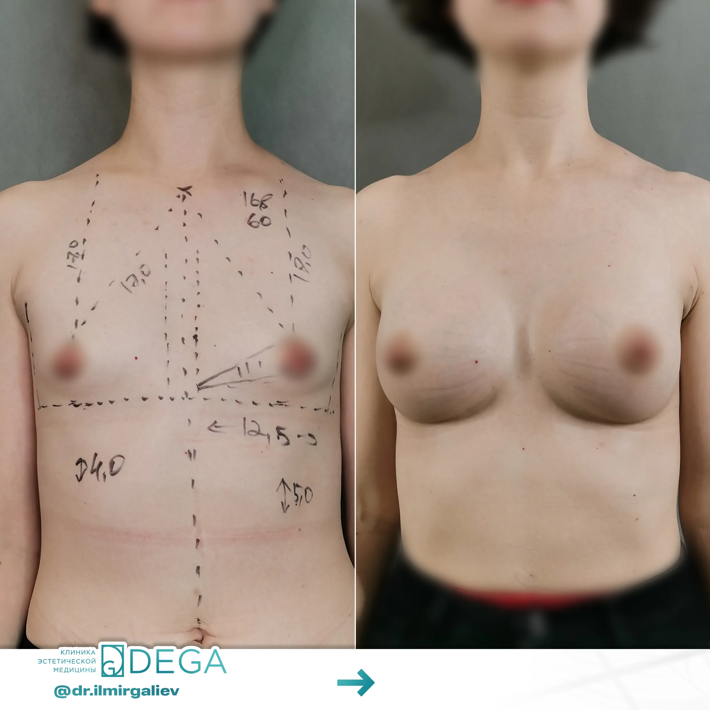 Галиев Ильмир Амирович №1.1 Маммопластика Увеличение груди