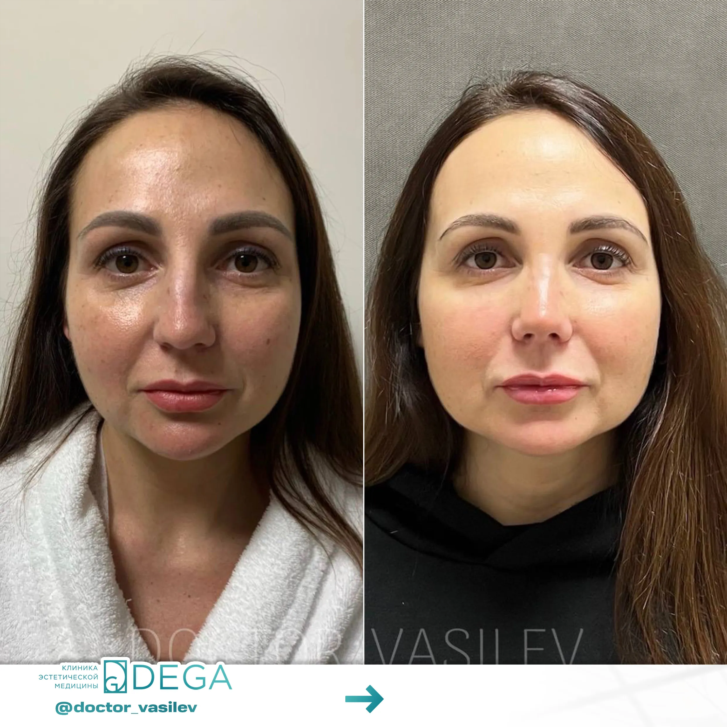 Васильев Д.О. - Ринопластика №89