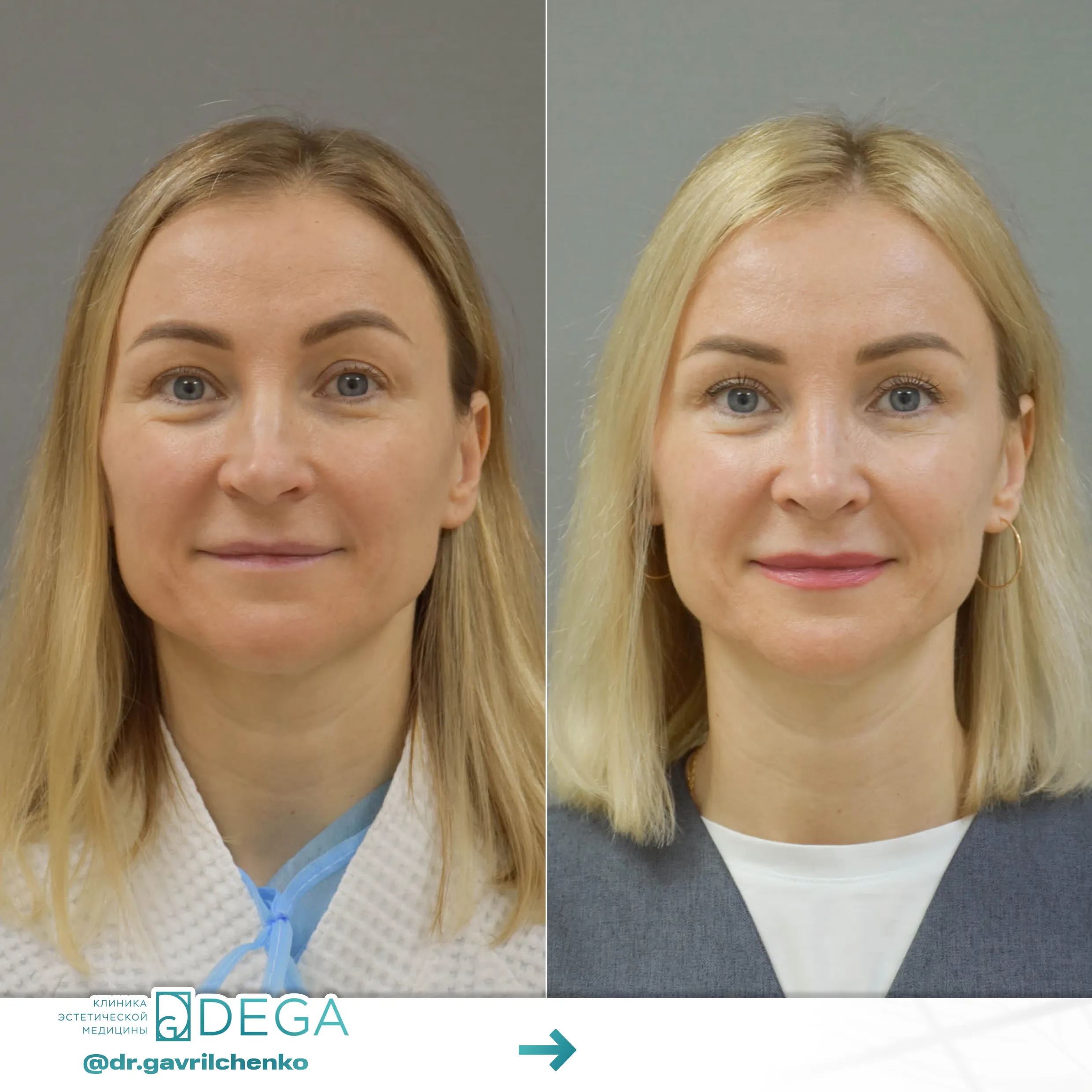 Гаврильченко АА - Ринопластика №61