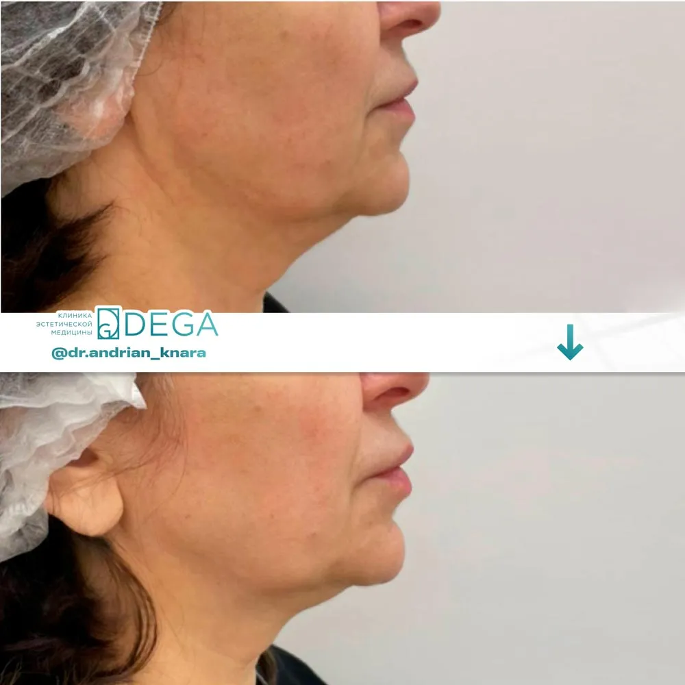 Андрян КВ - SMAS-лифтинг №3