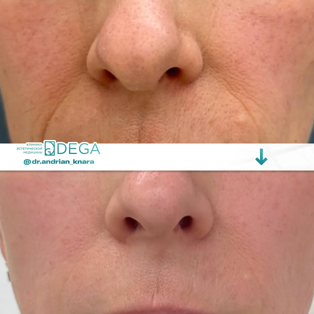 Андрян КВ - RF-лифтинг №20