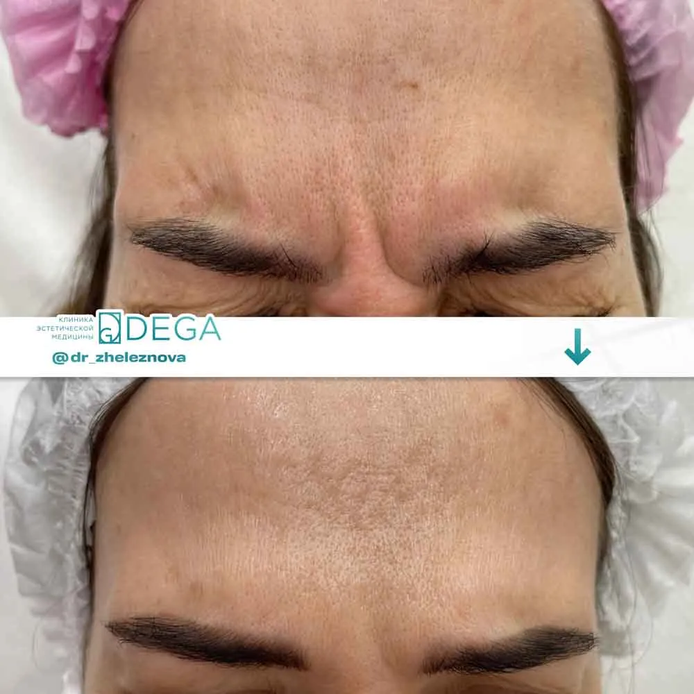 Железнова Яна Алексеевна - Ботокс №6