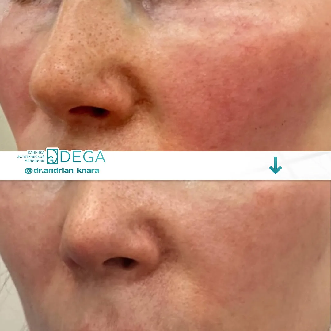 Андрян КВ - RF-лифтинг №21