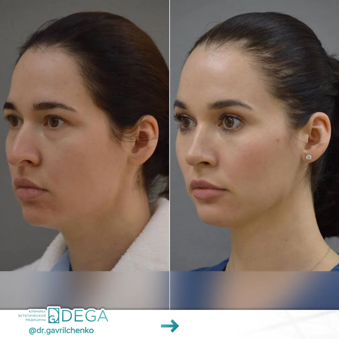 Гаврильченко АА - Эндоскопическая периорбитопластика, Ринопластика №41