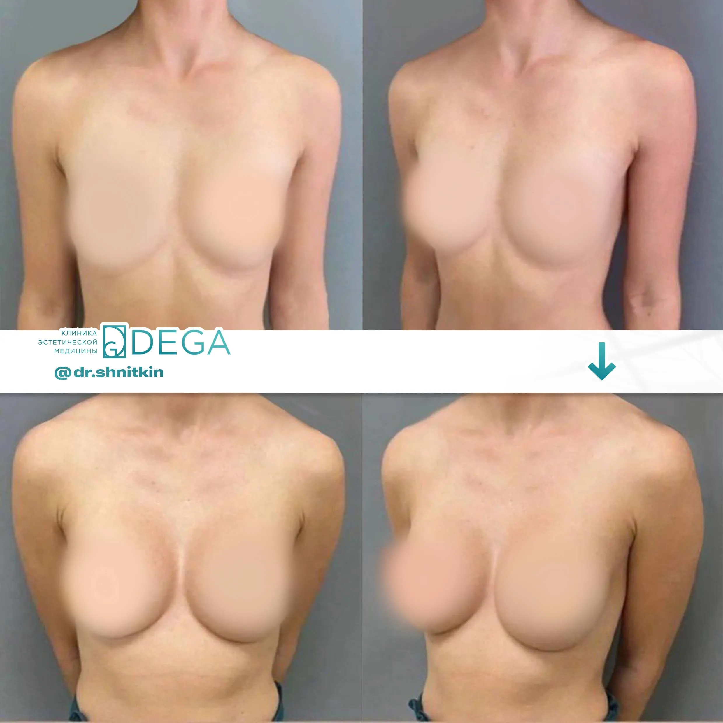 Шниткин Антон Сергеевич №16 Маммопластика Увеличение груди