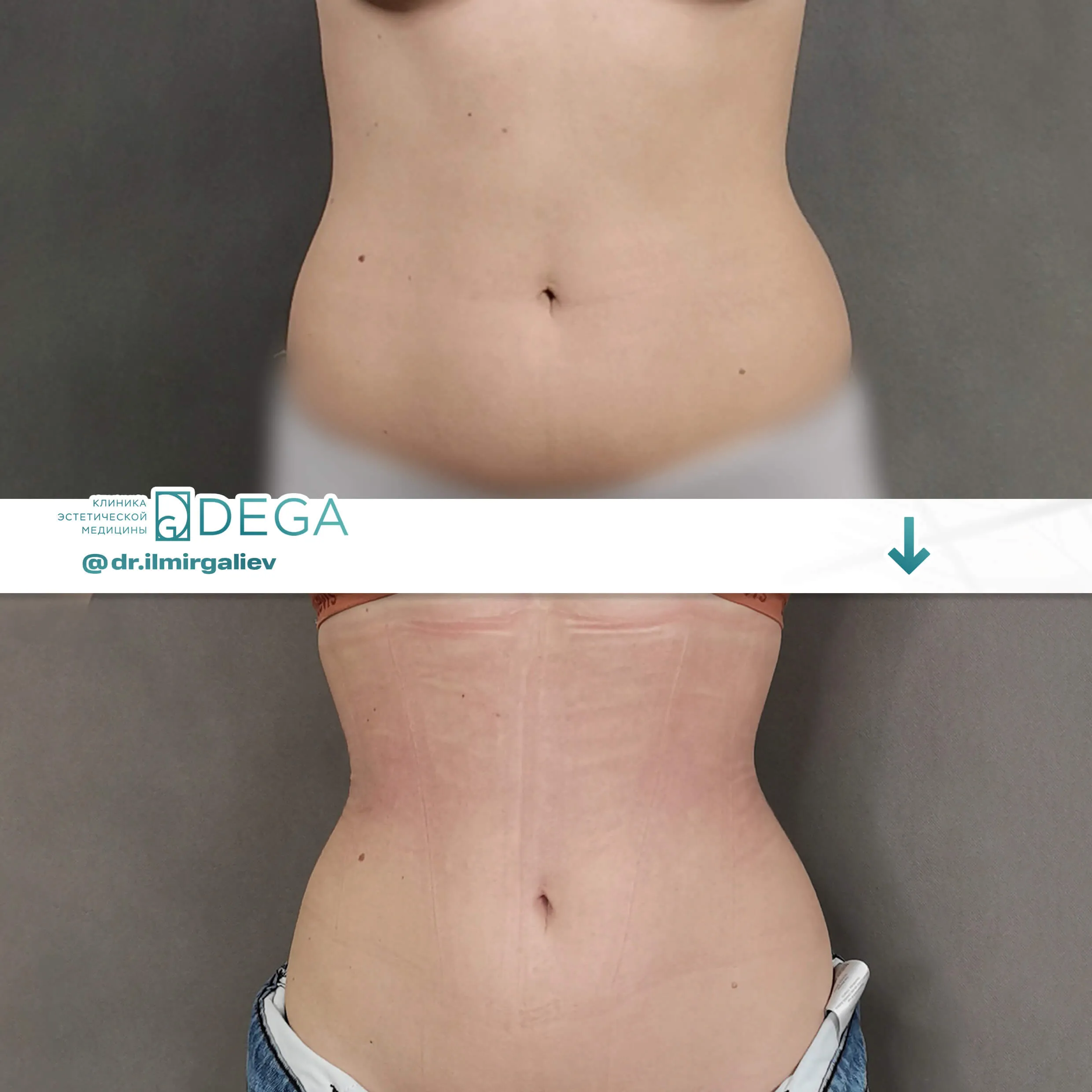 Галиев Ильмир Амирович №8.1 Уменьшение талии по методике Кудзаева