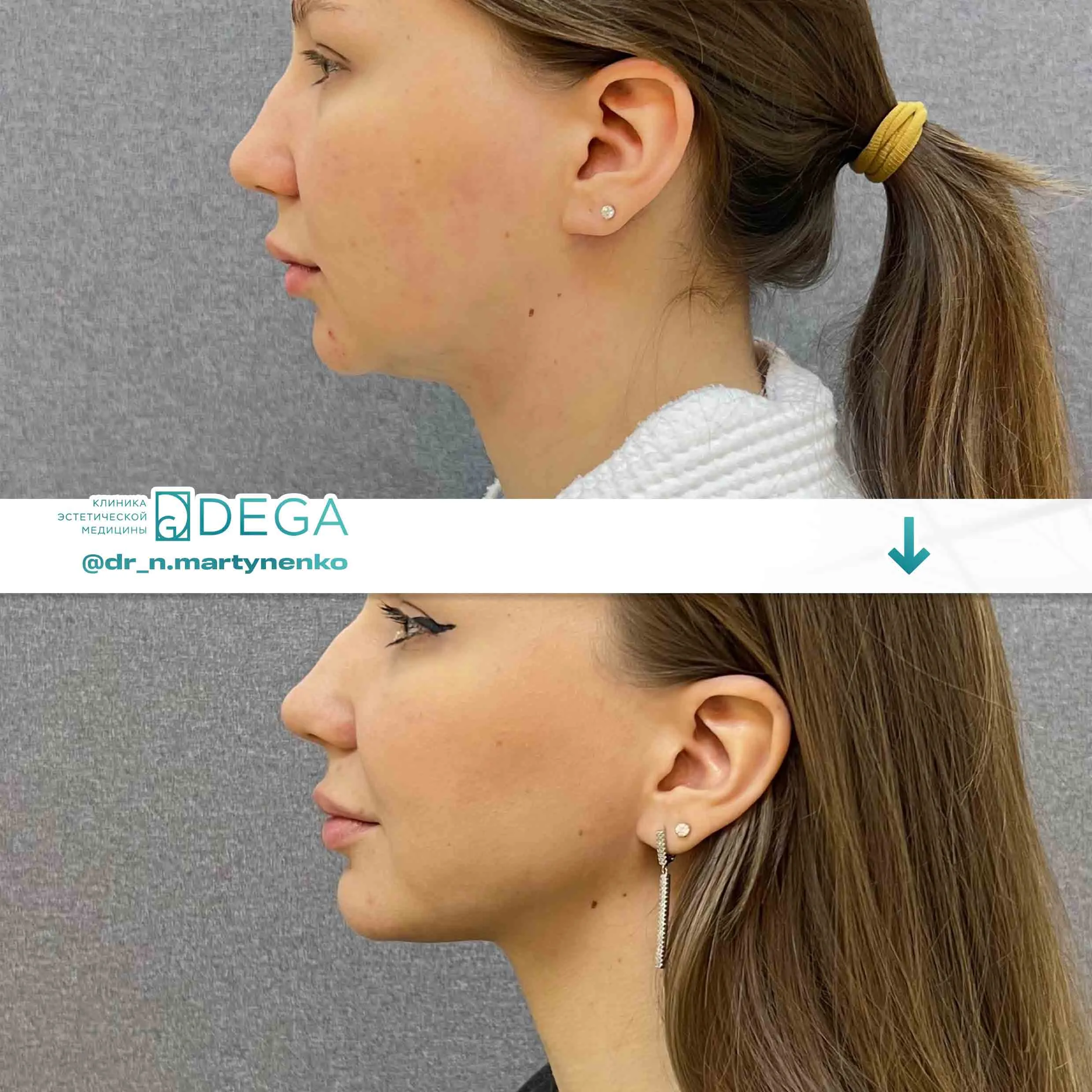 Мартыненко Н. А. — №3 Липосакция подбородка