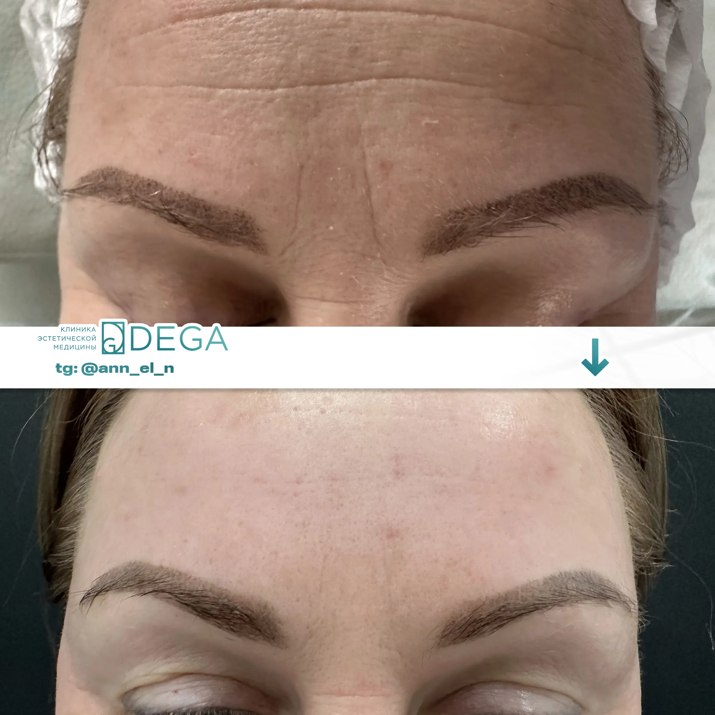 Дулмаева А.О. - Ботулинотерапия №1