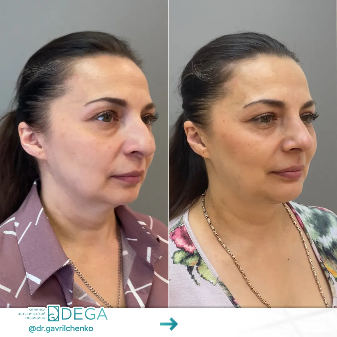 Гаврильченко АА - Ринопластика №24