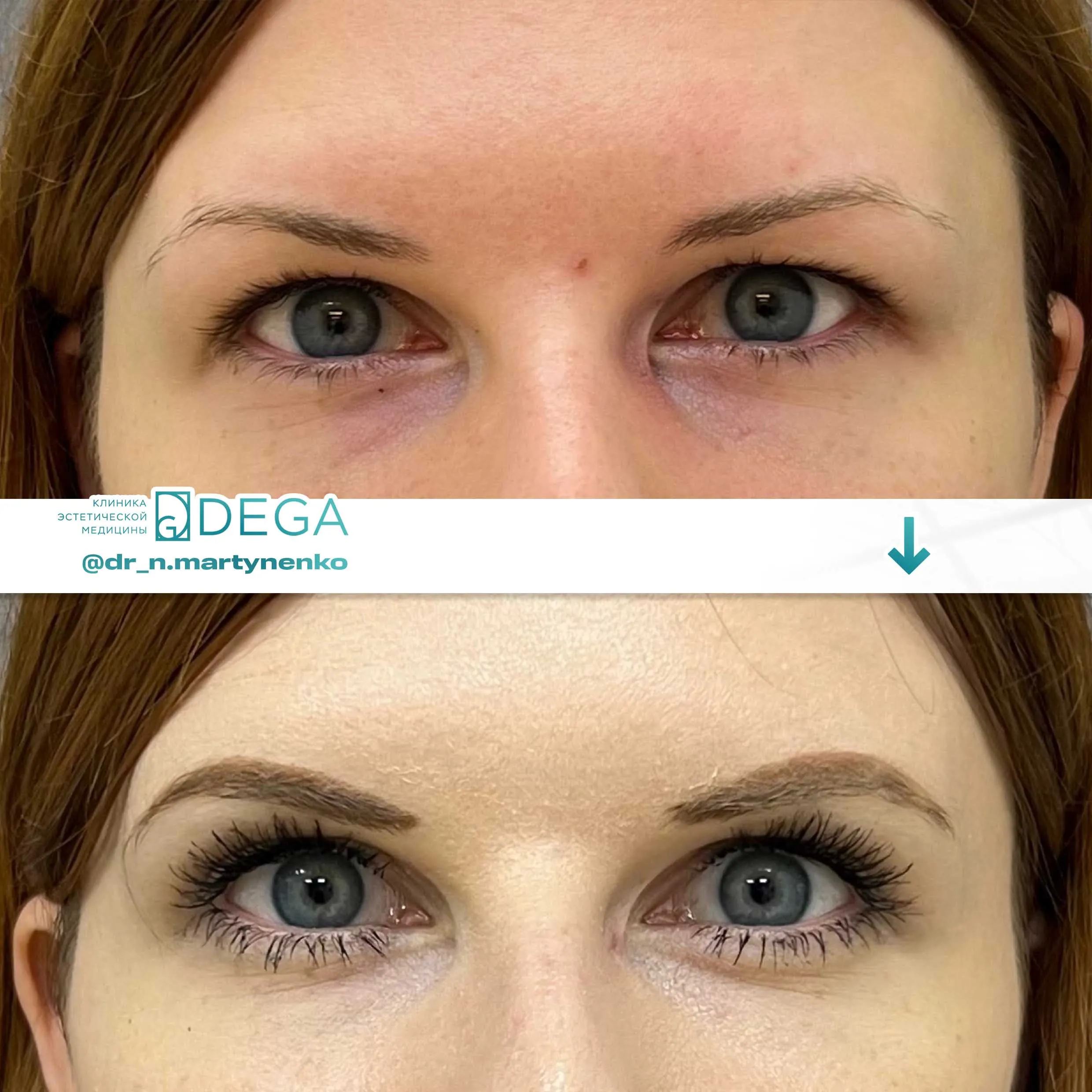 Мартыненко Н. А. — №9 Блефаропластика верхних век