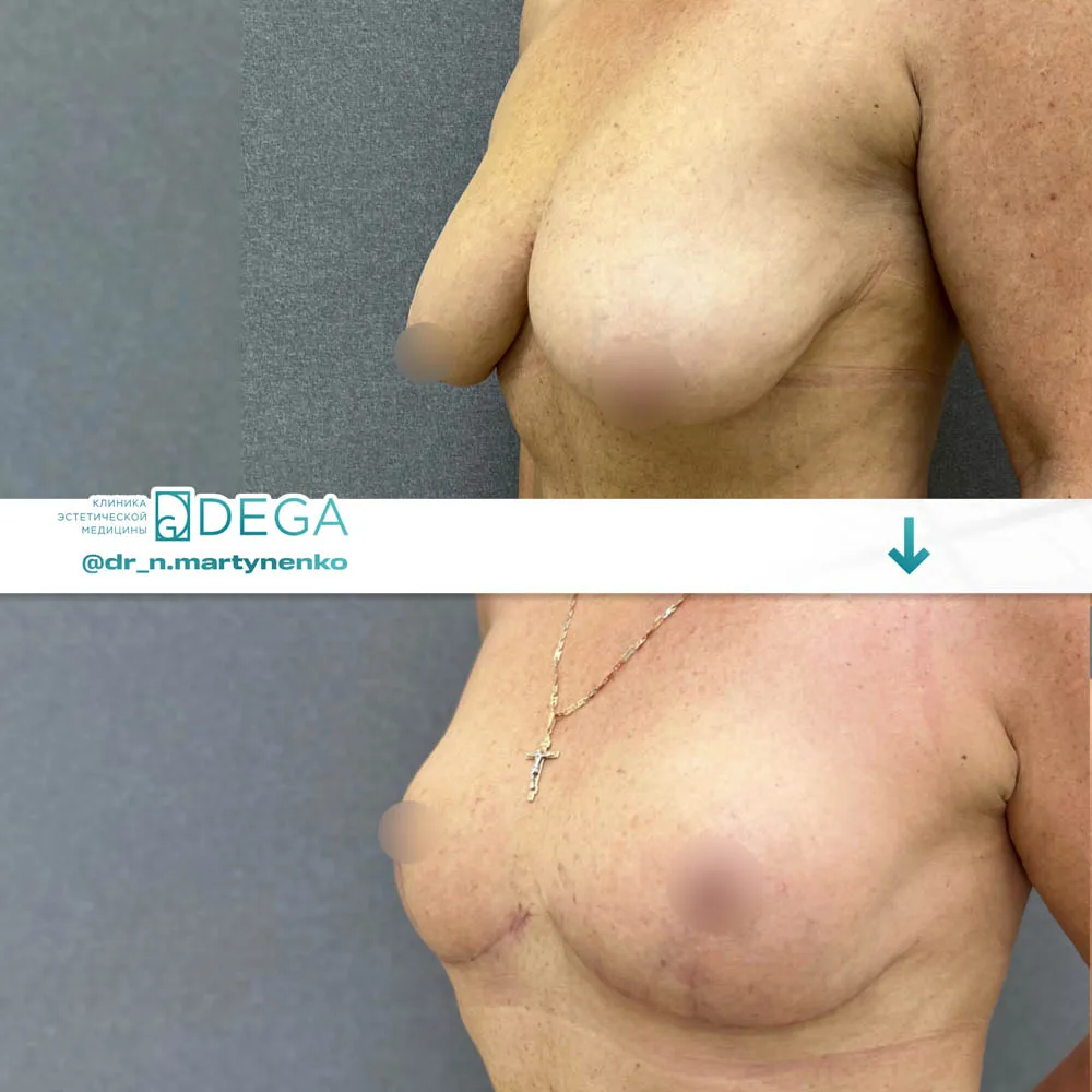 Мартыненко Н.А. - Л Редукционная маммопластика, Мастопексия №49