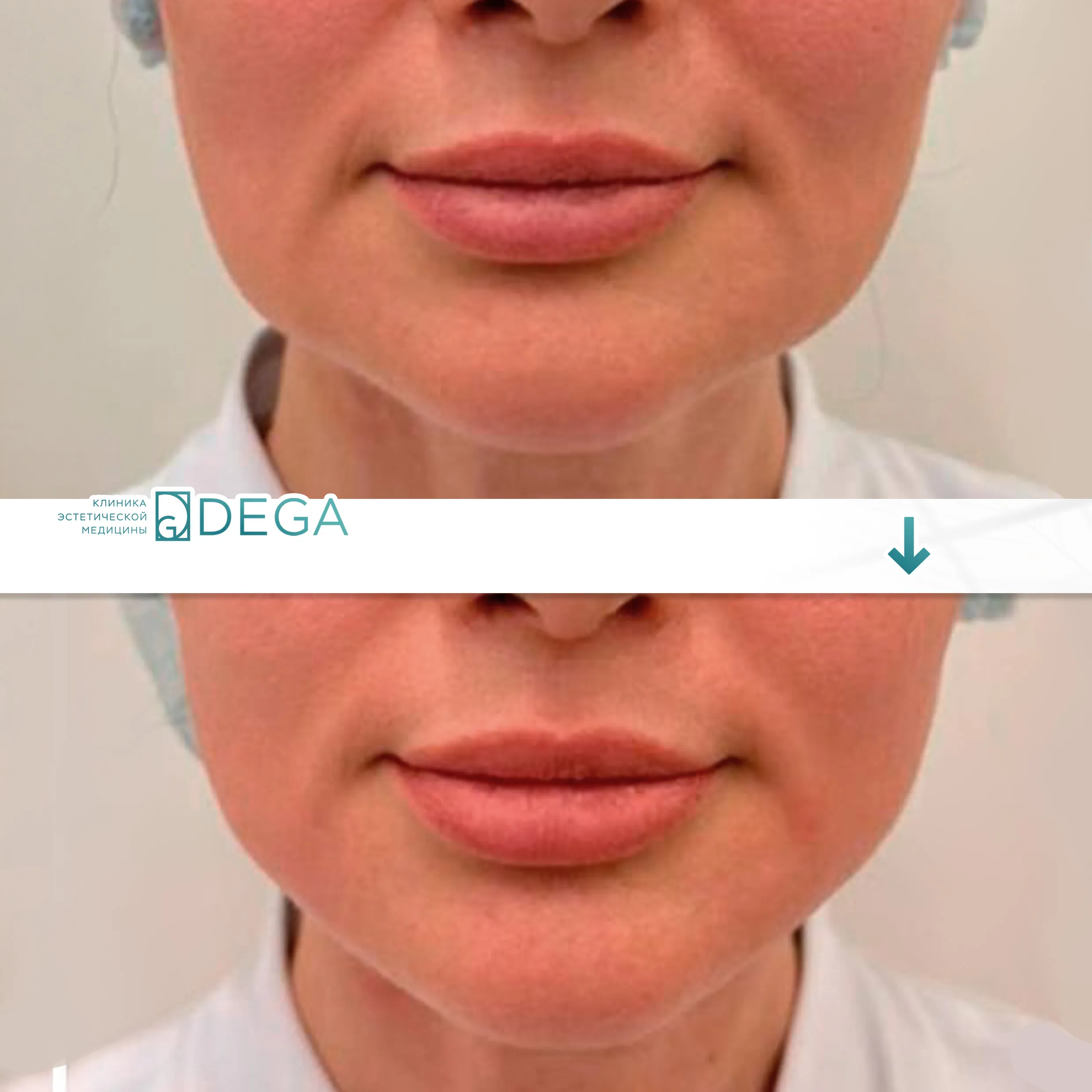 Клиника DEGA - Монополярный RF-лифтинг Oligio