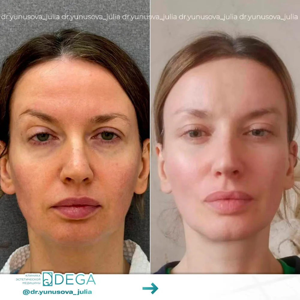 Юнусова ЮР - Эндоскопическая подтяжка лица №45