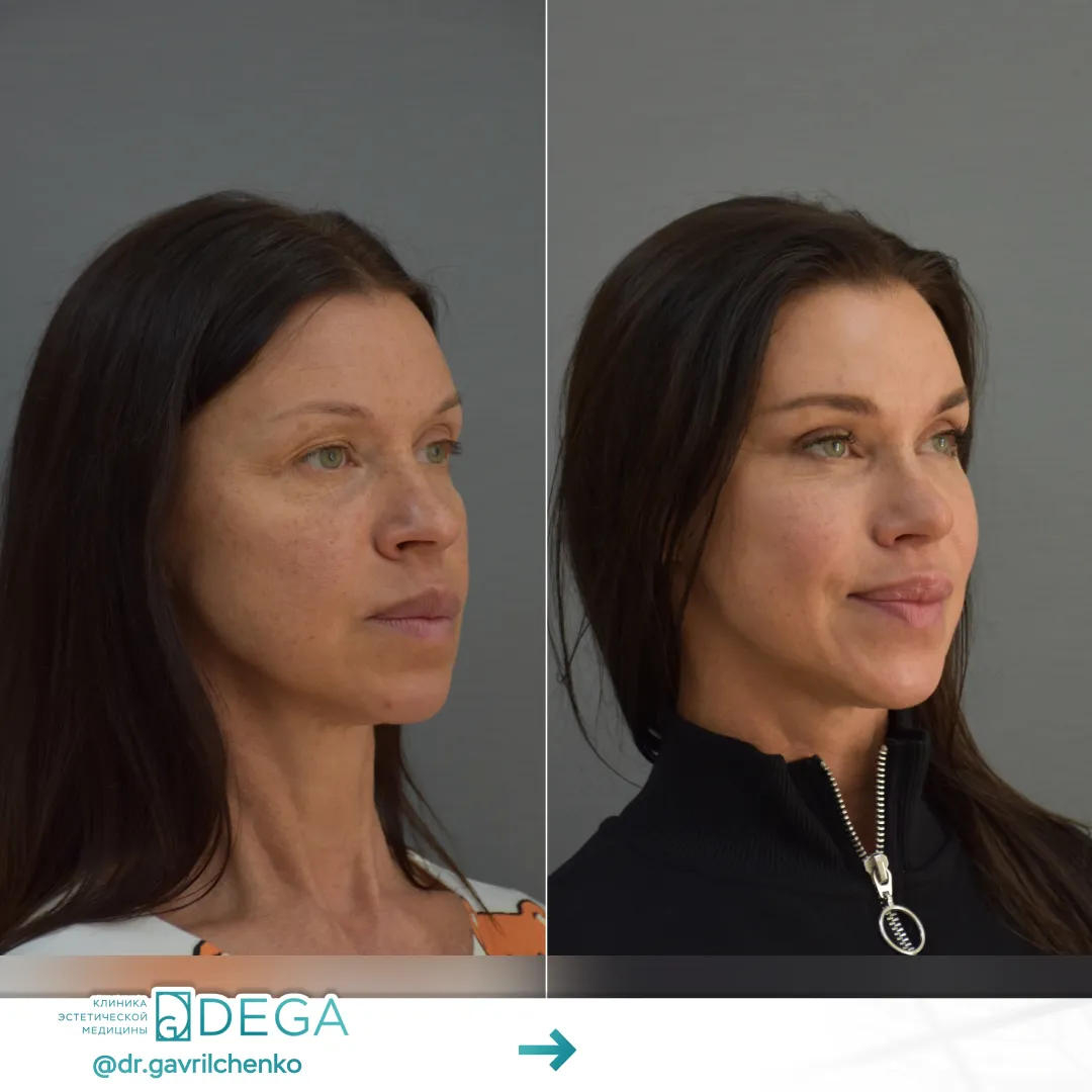 Гаврильченко АА - Эндоскопическая периорбитопластика, Ринопластика №38