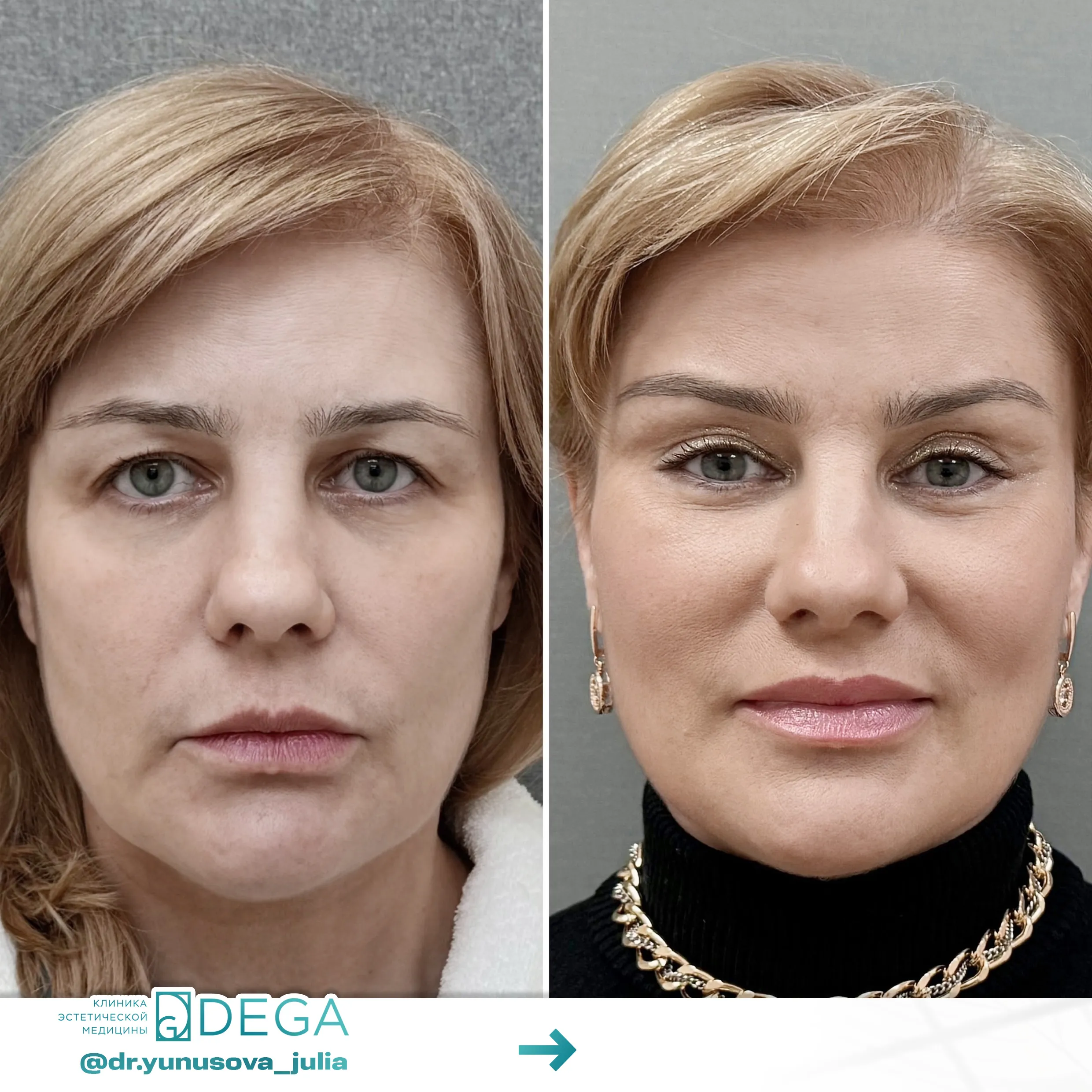Юнусова ЮР - Эндоскопическая подтяжка лица №55
