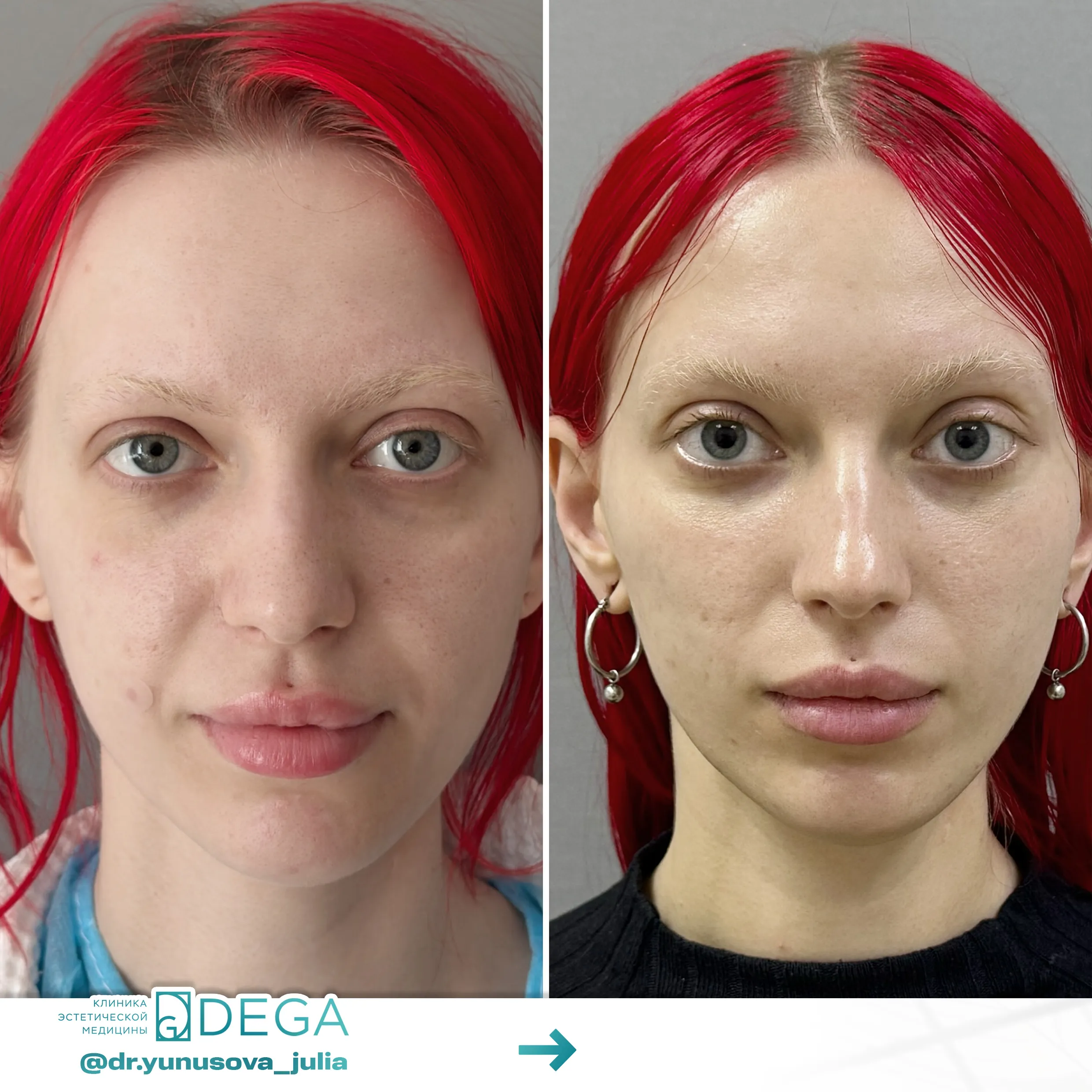 Юнусова ЮР - Эндоскопическая подтяжка лица, Блефаропластика нижних век №49