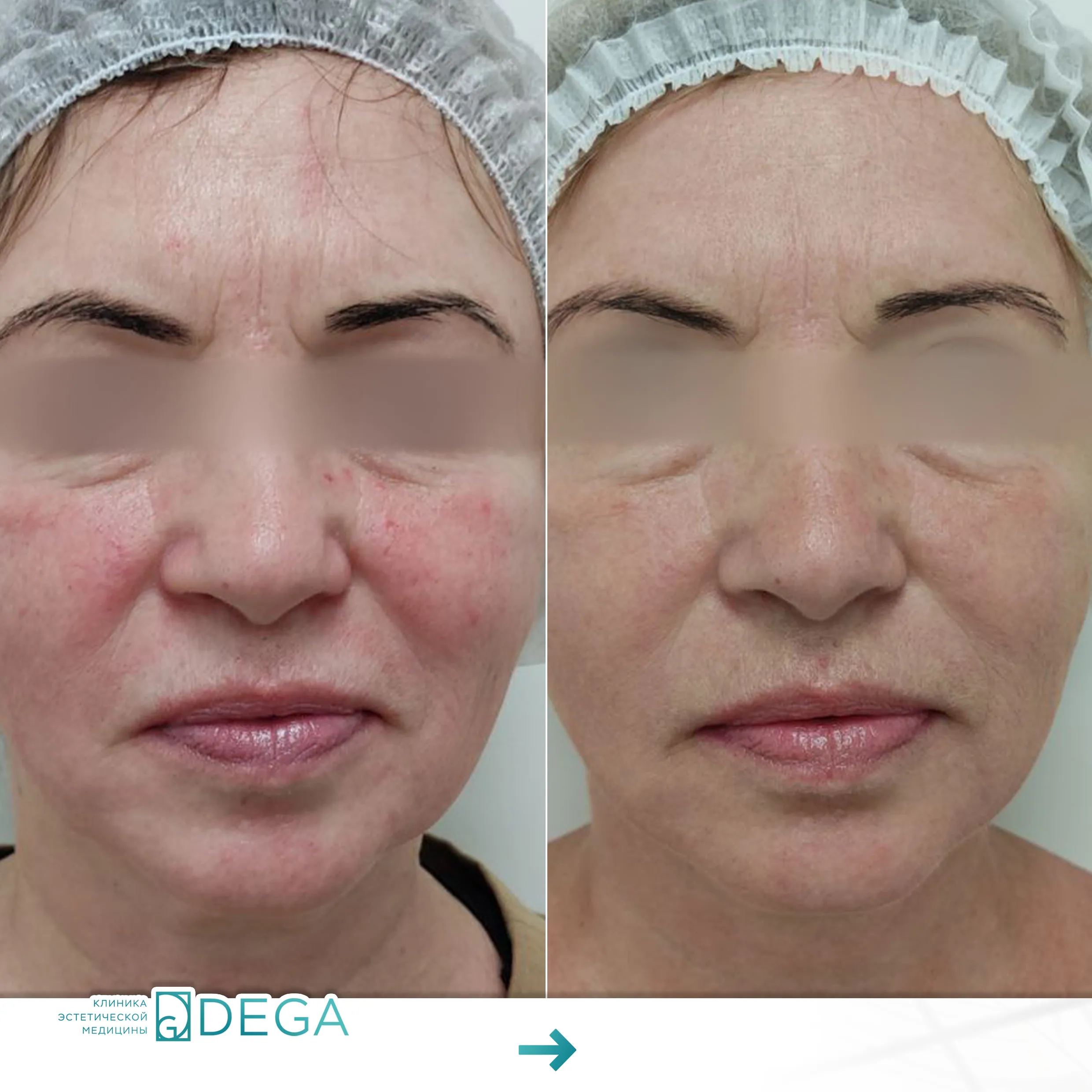 Бабичева С.Ю. —  Фотодинамическая терапия №11