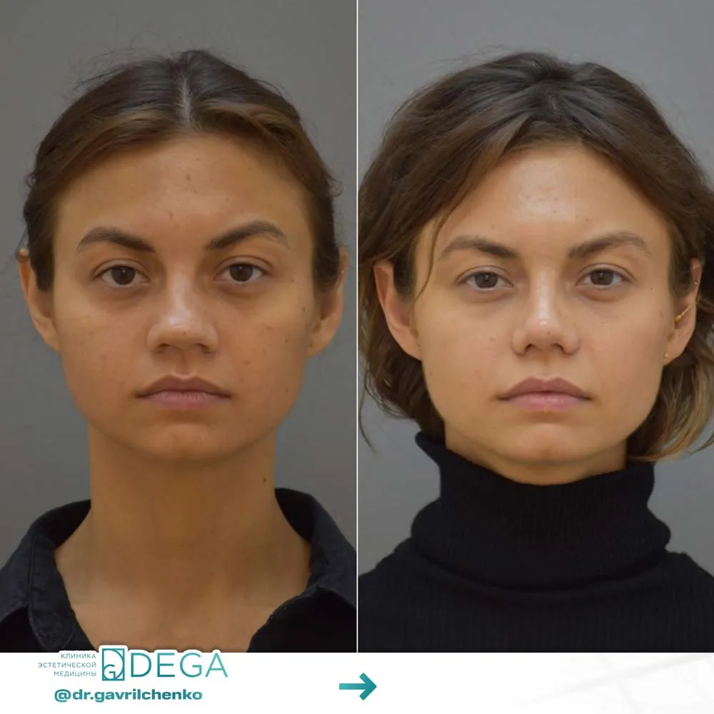 Гаврильченко АА - Ринопластика №47