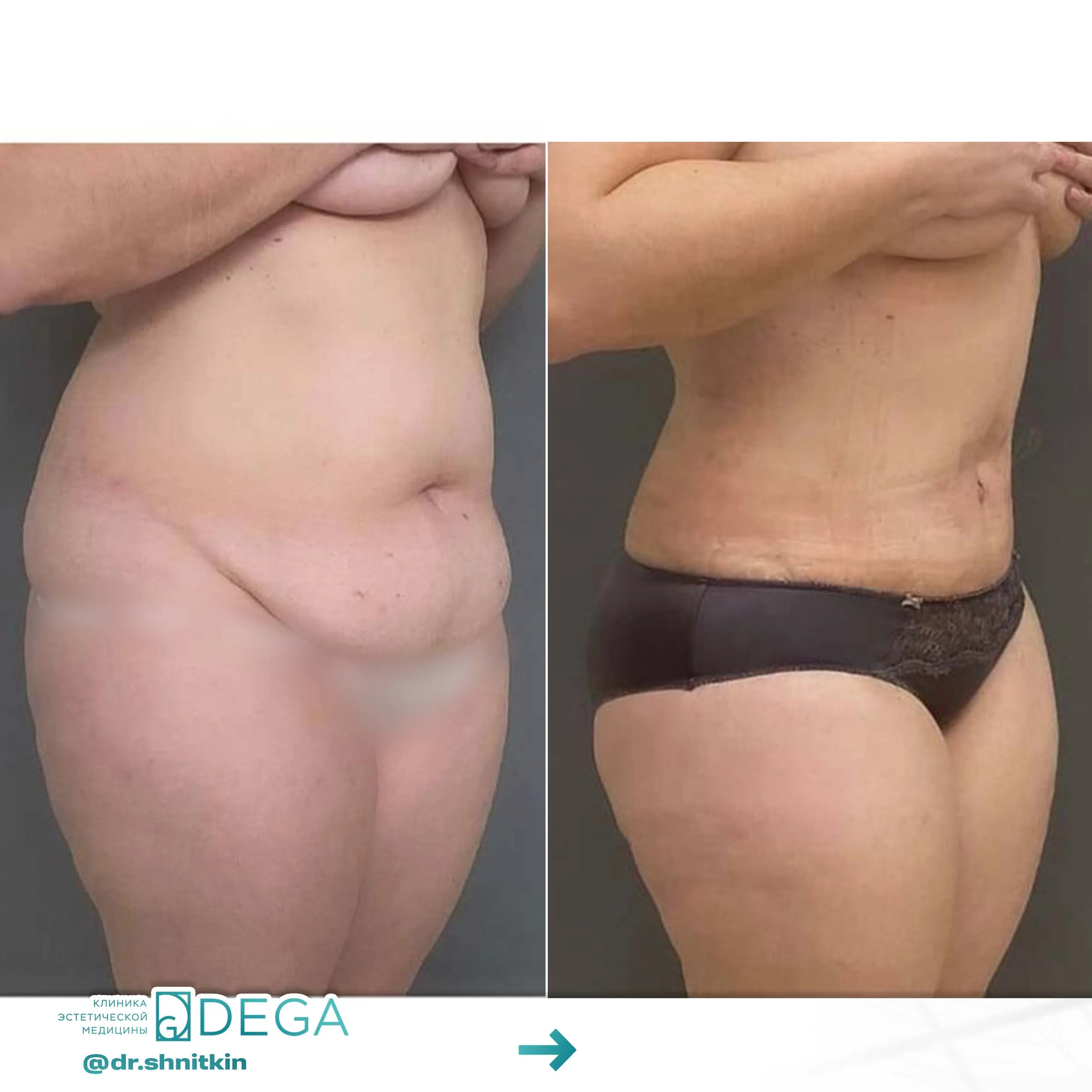 Шниткин Антон Сергеевич №22.1 Абдоминопластика (пластика живота) Пластика тела Липосакция живота